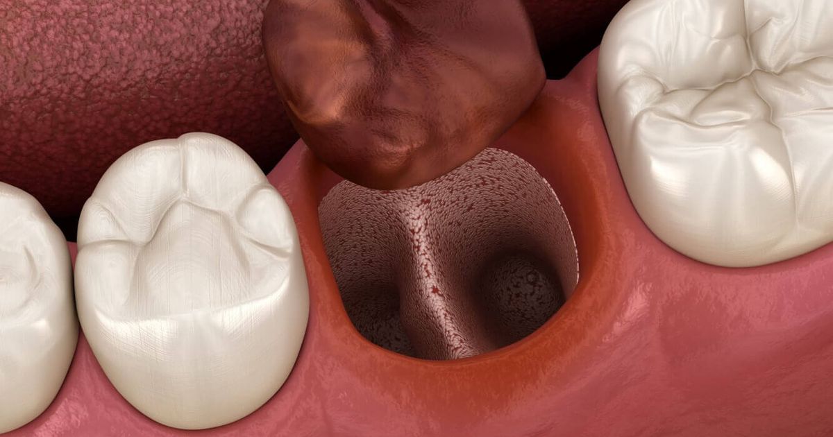 How to Prevent Dry Socket? | Affordable Dentures & Implants How to Prevent Dry Socket? | Affordable Dentures & Implants