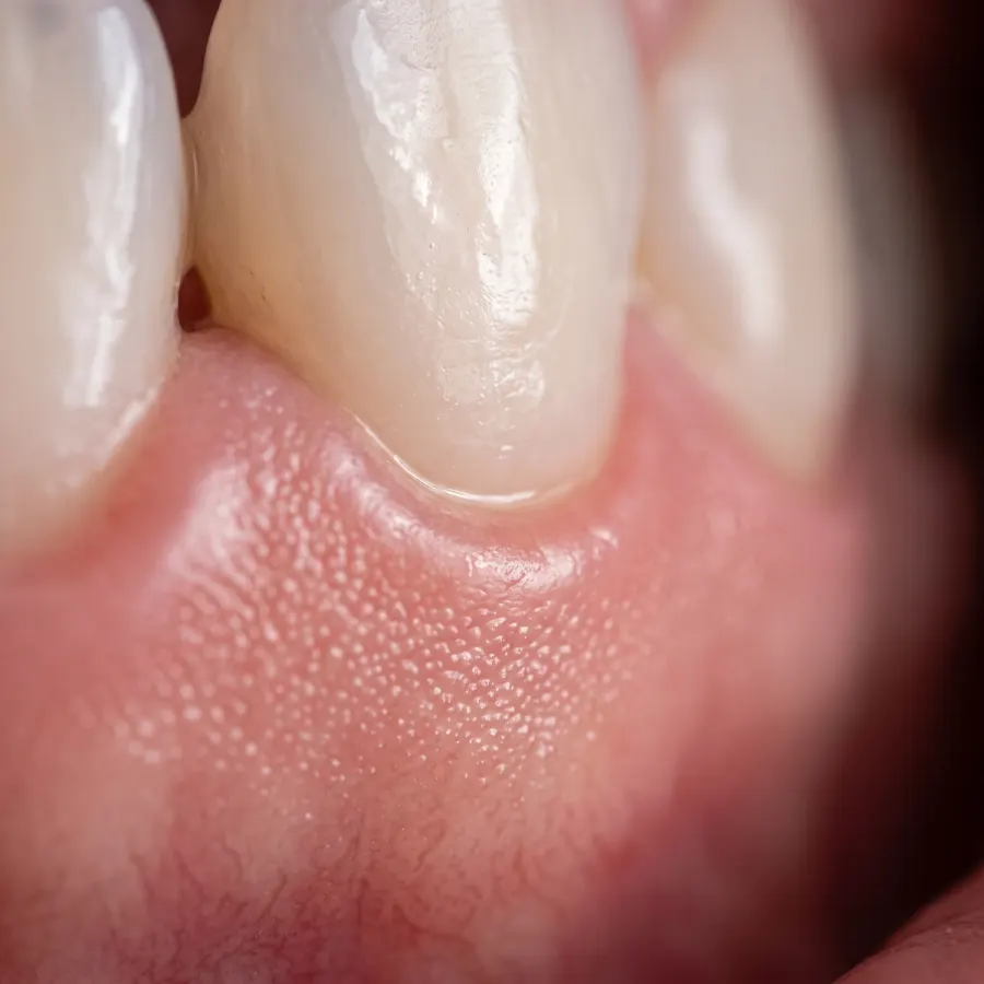 Periodontal Therapy