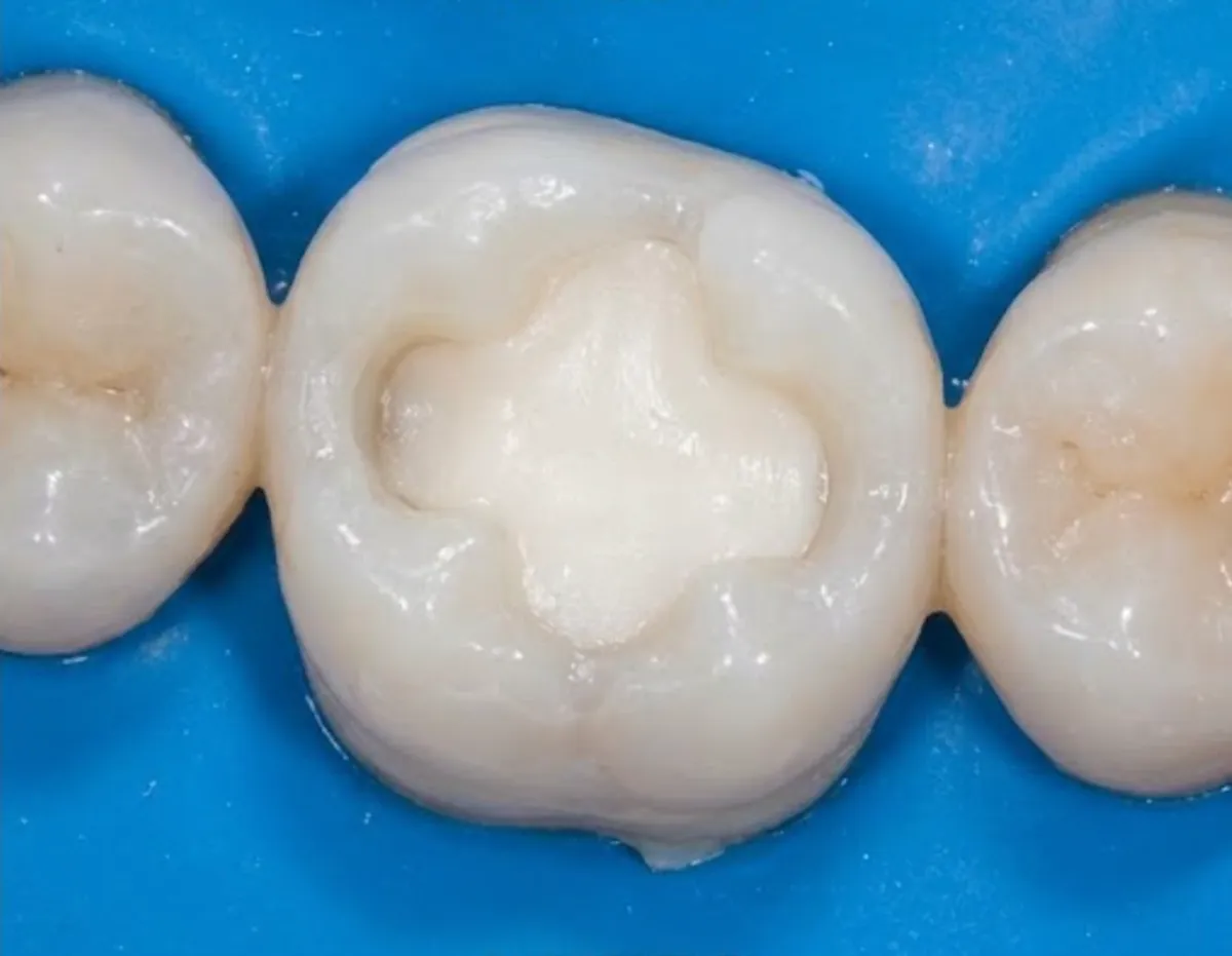 After: Molar root canal treatment