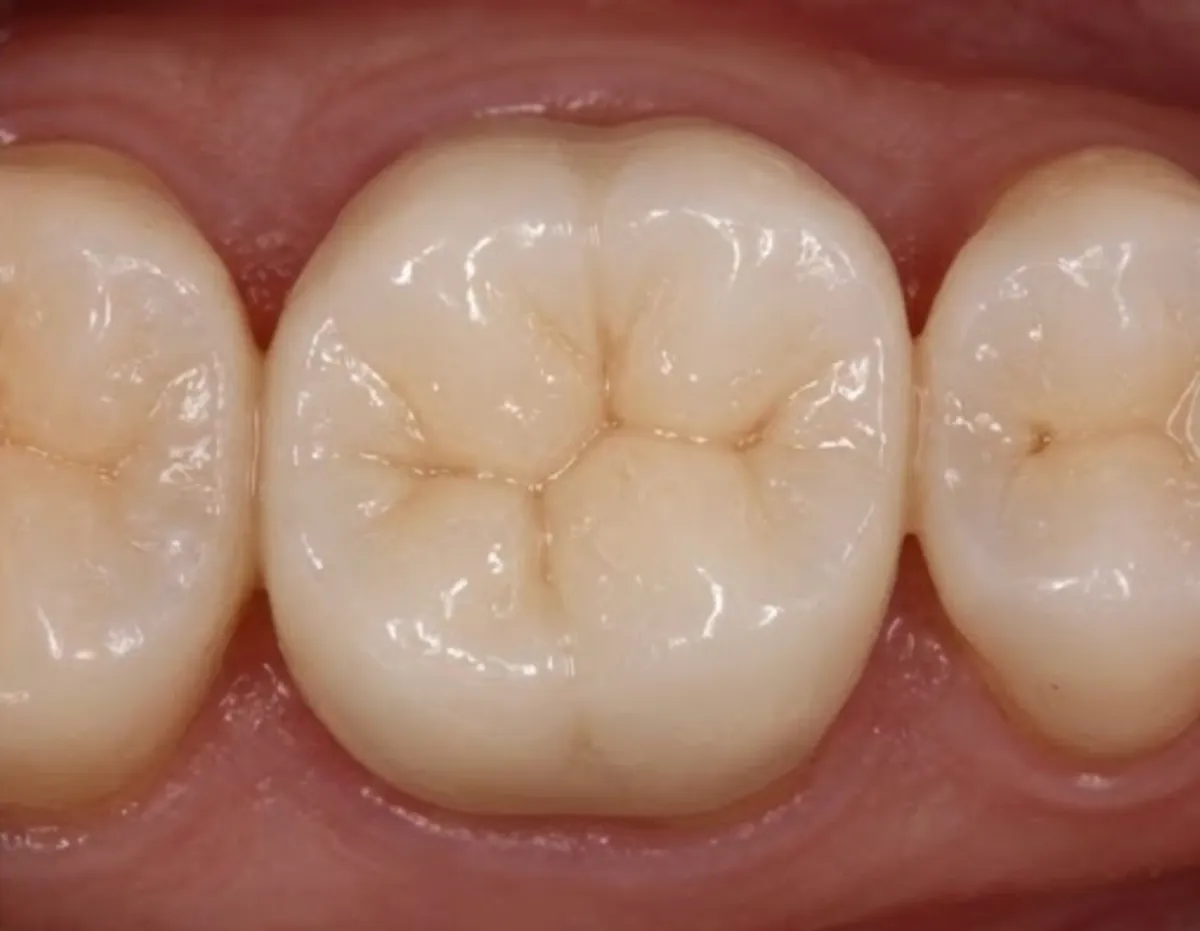 After: Ceramic crown on a root-treated premolar