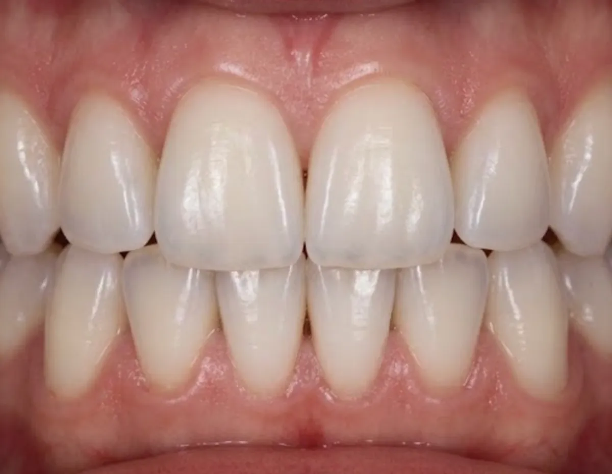 After: Home whitening before bonding