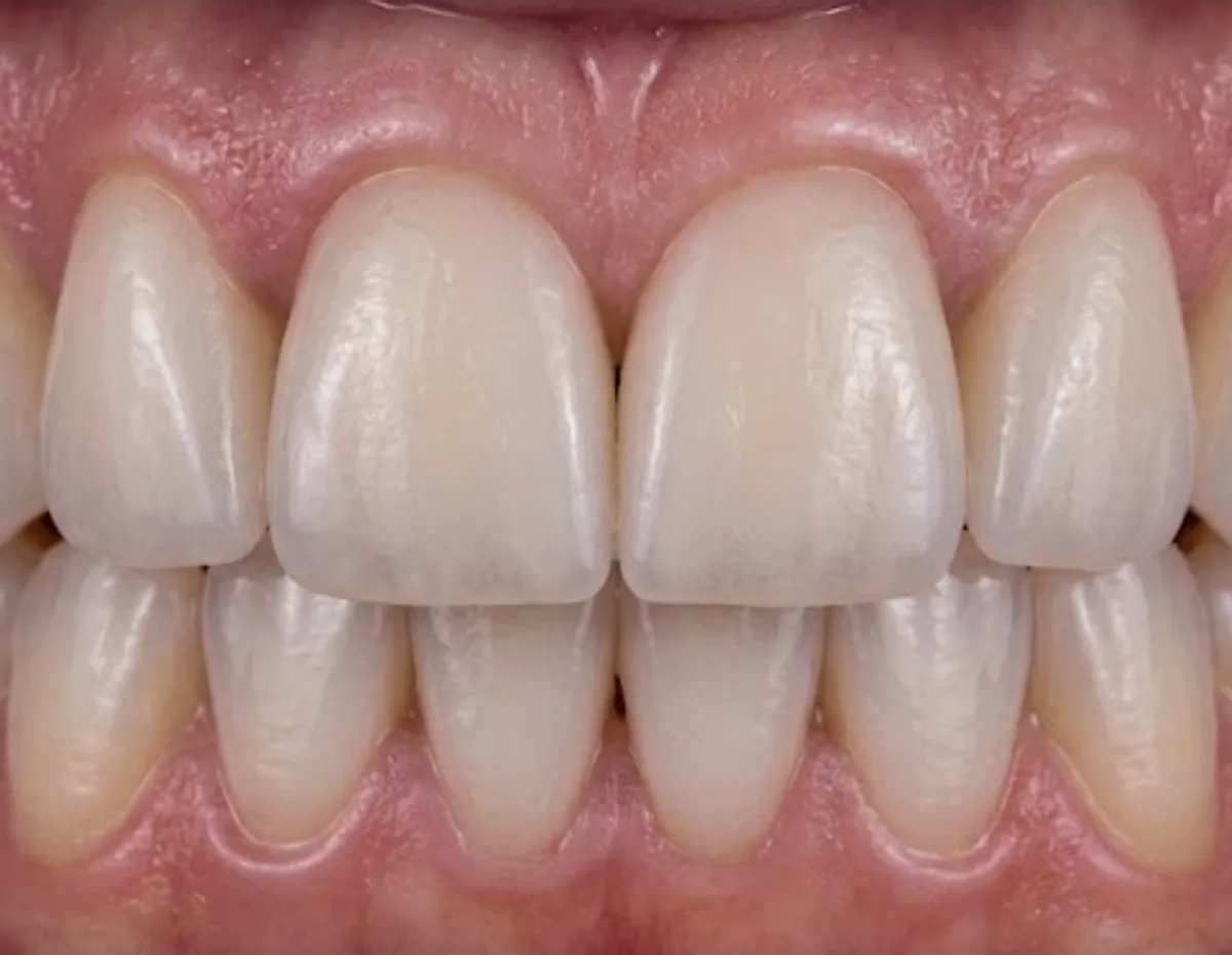 After: Upper veneers after edge wear