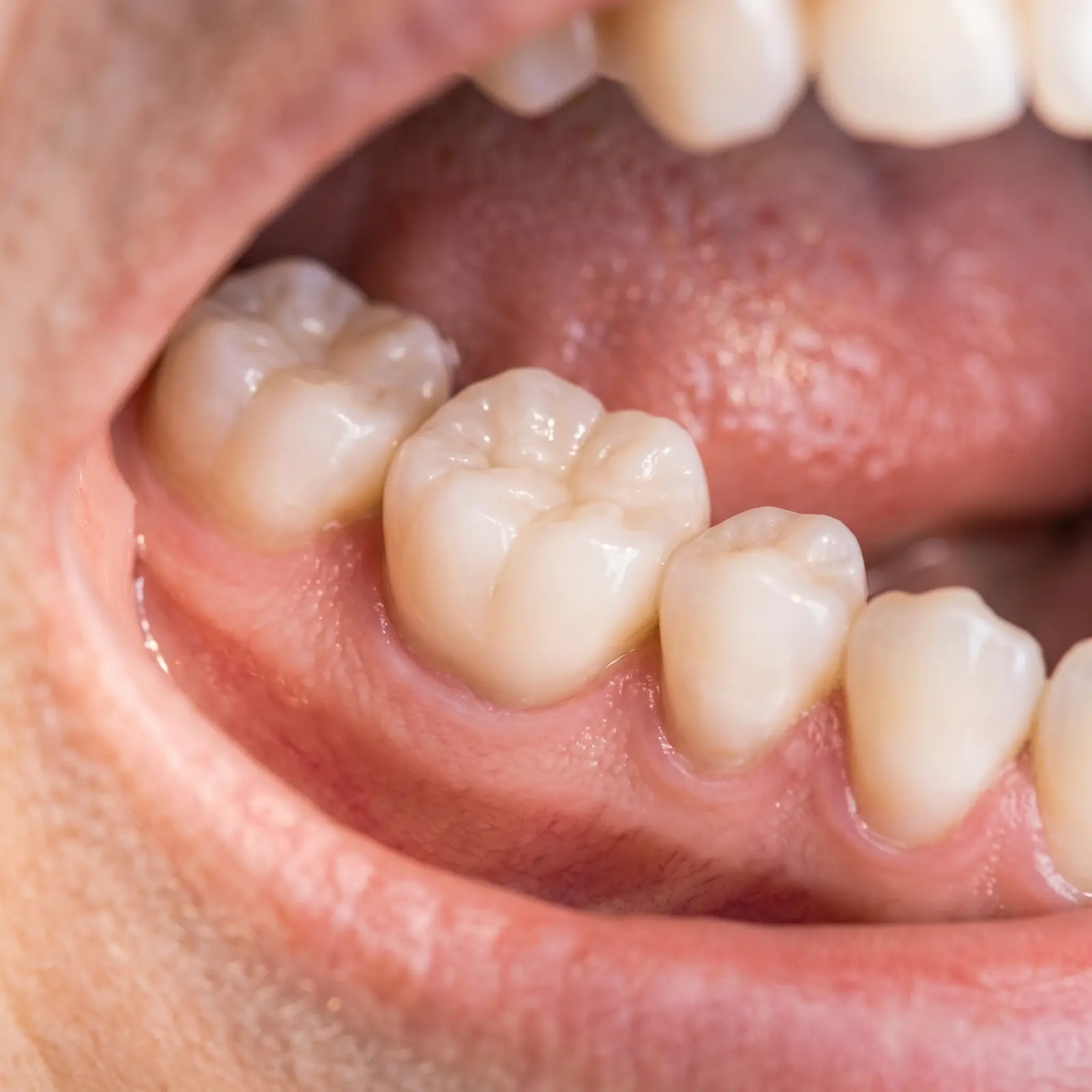 Single Dental Implant