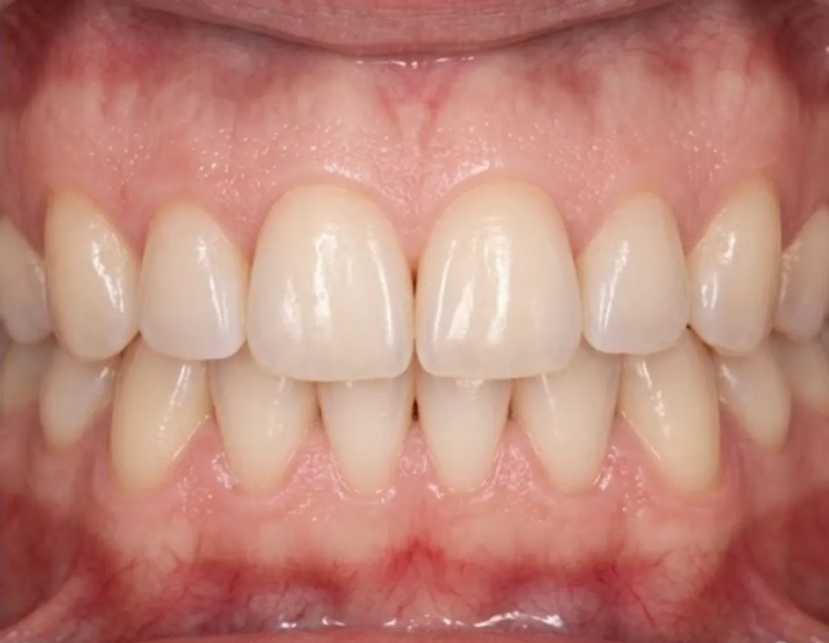 After: Pocket reduction after periodontal therapy