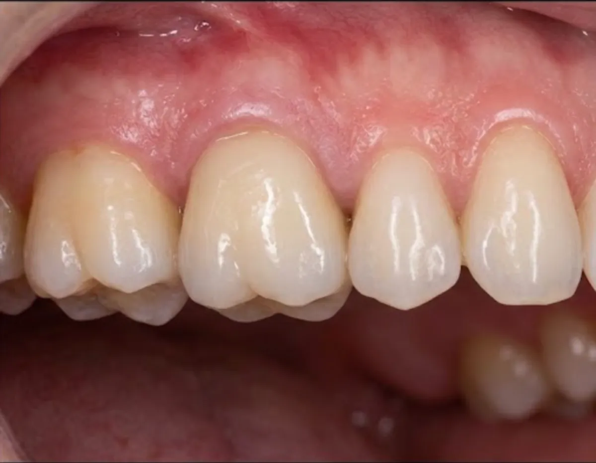 After: Single implant to replace an upper molar