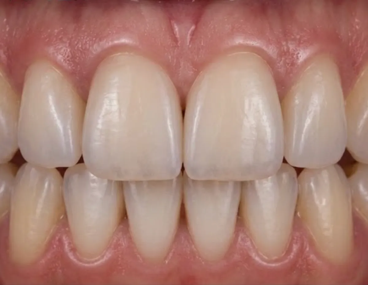 After: Composite bonding to close small gaps
