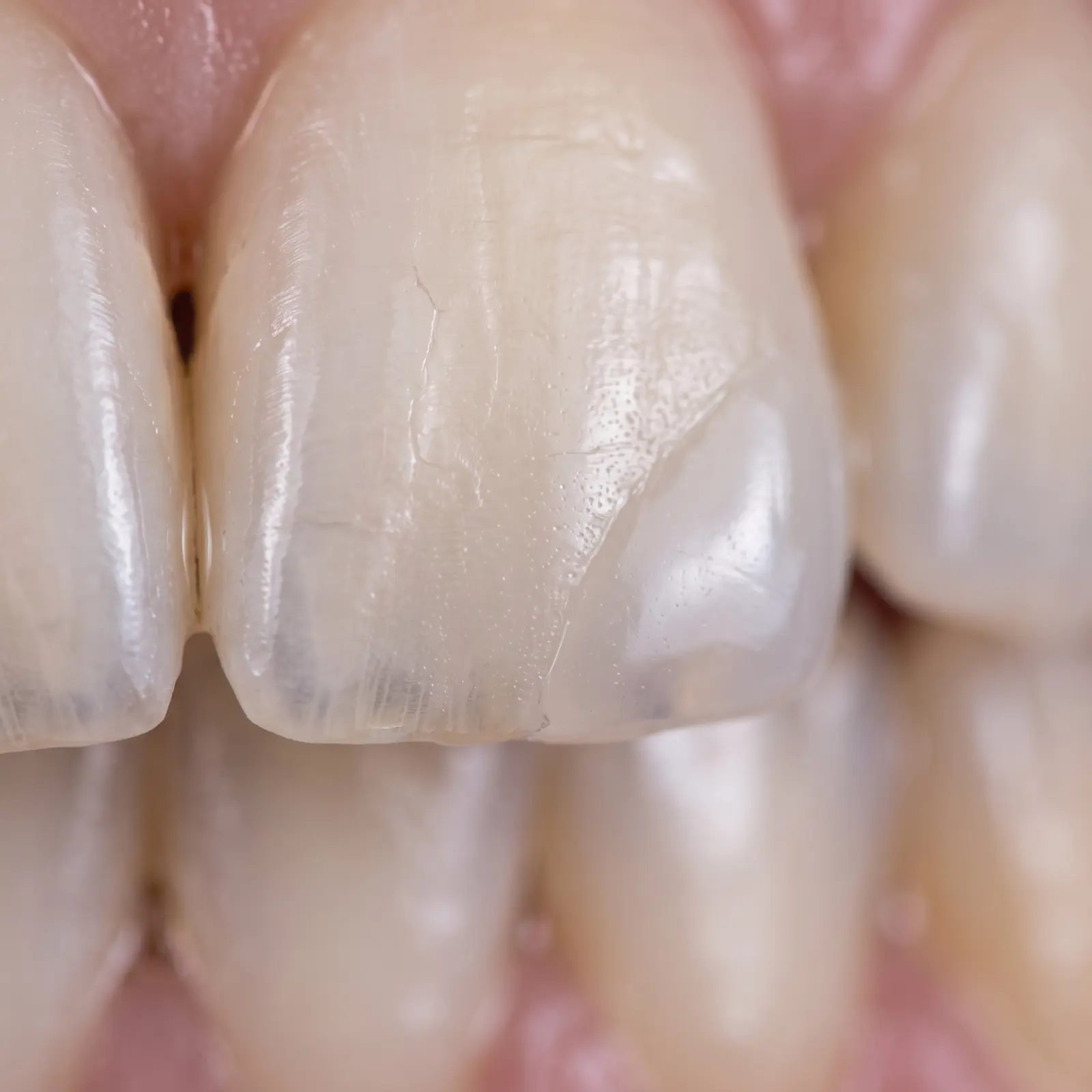 Composite Bonding
