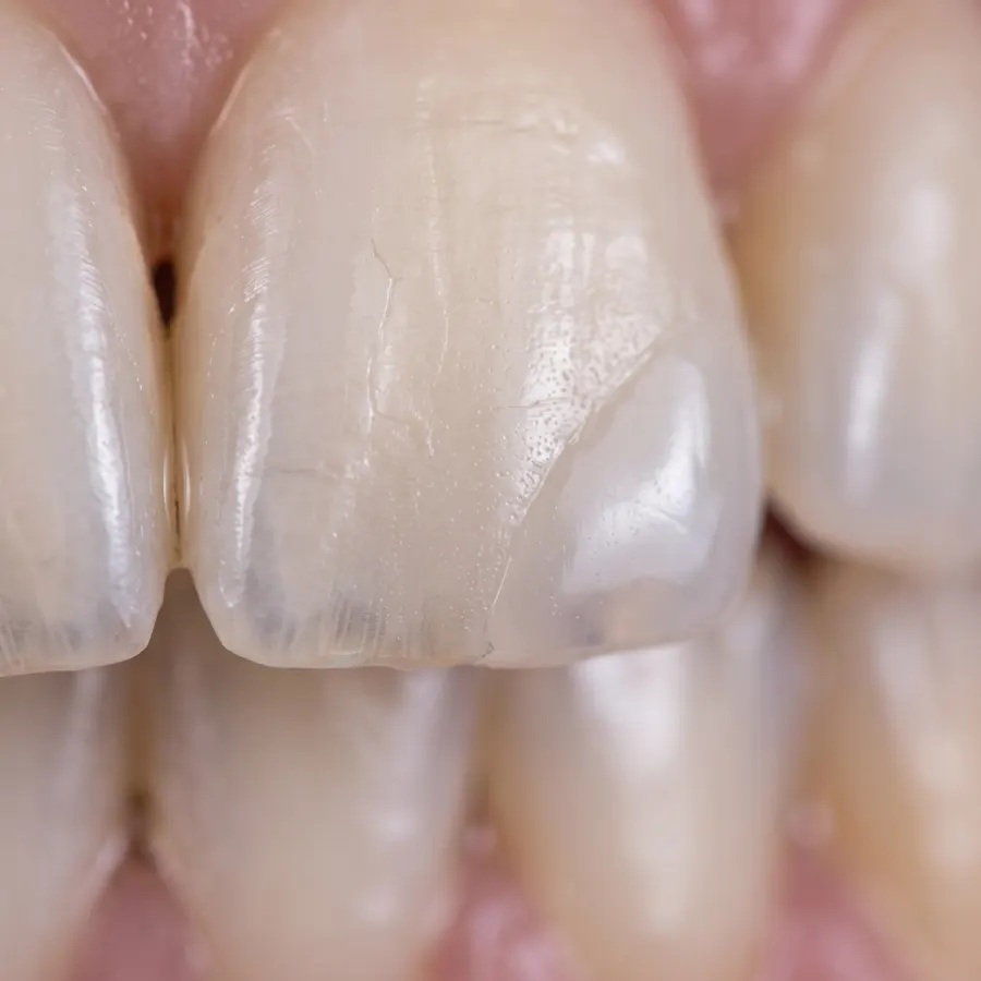 Composite Bonding