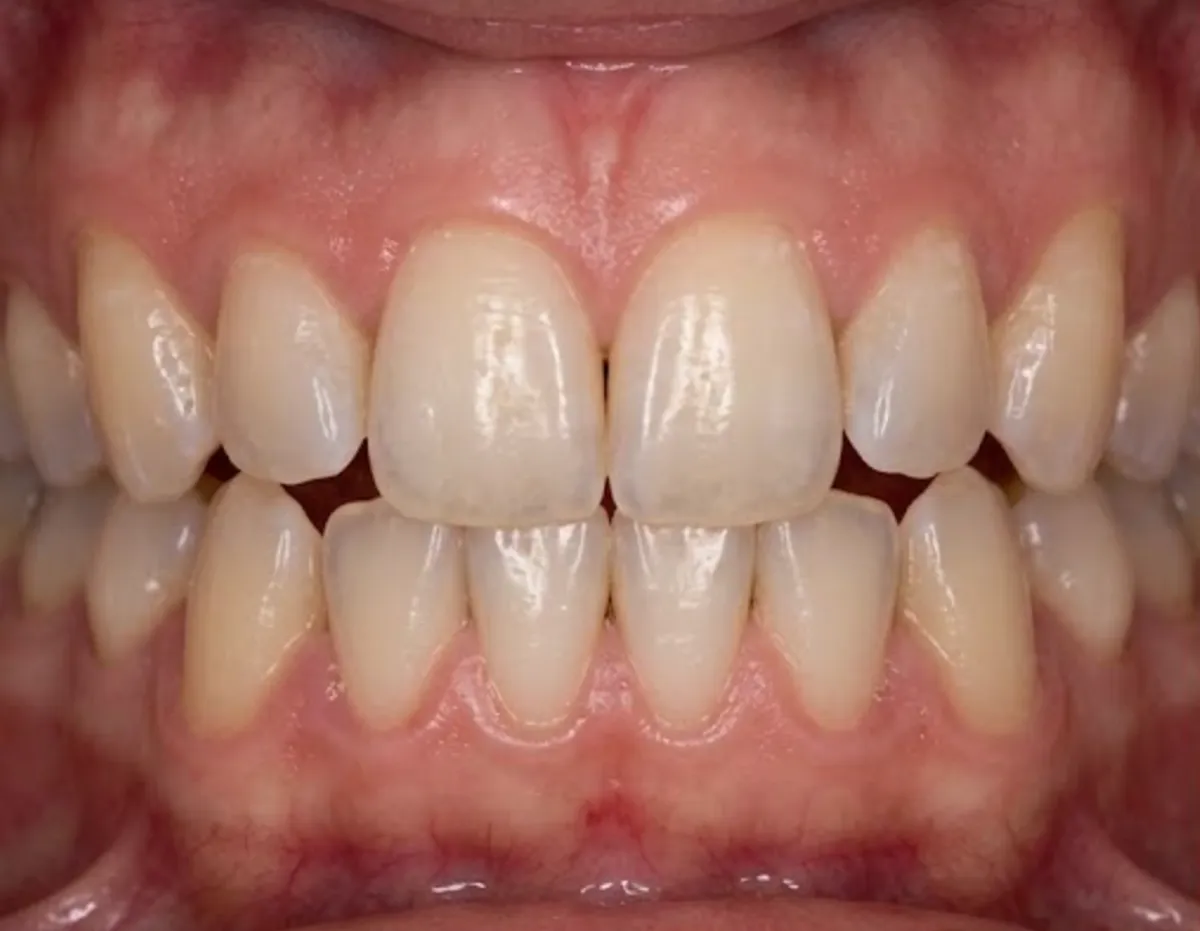 After: Adult aligners for crowding