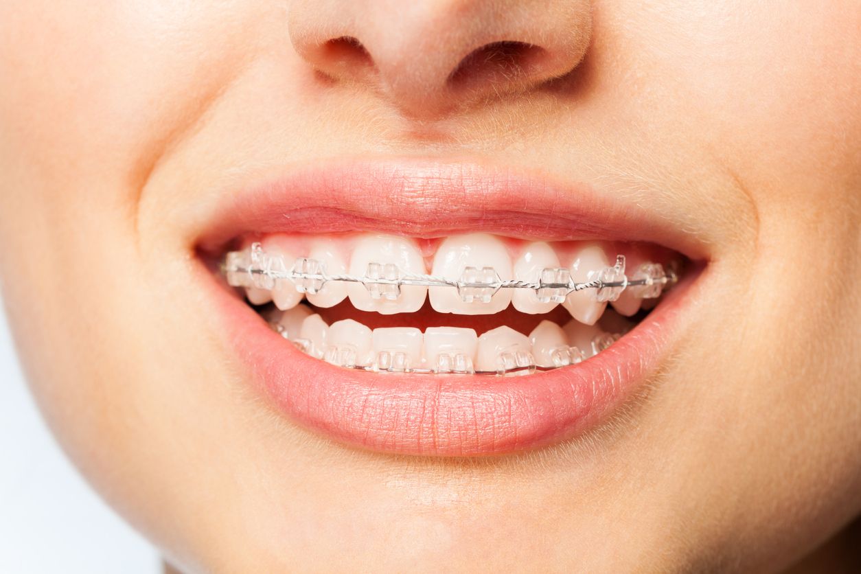 Image showing young woman with clear bracket braces on her teeth
