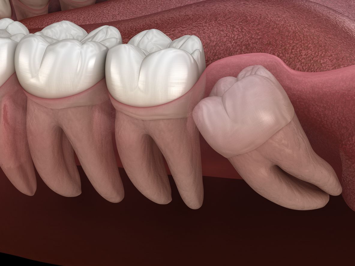 Illustration showing wisdom tooth impacted in gums