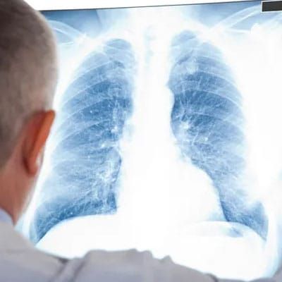 Imagine of a patient's lungs.