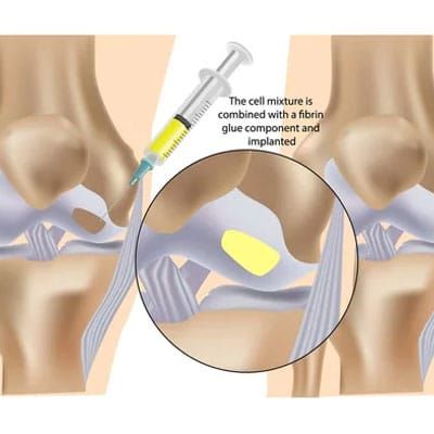 Image depicting joint injection.