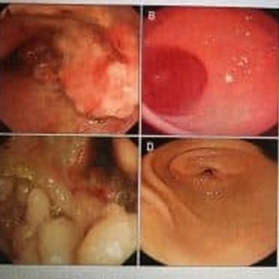 4 photos depicting ulcerative colitis.