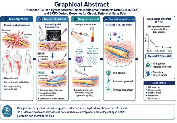 Hydrodissection with SPSCs effective against chronic nerve pain