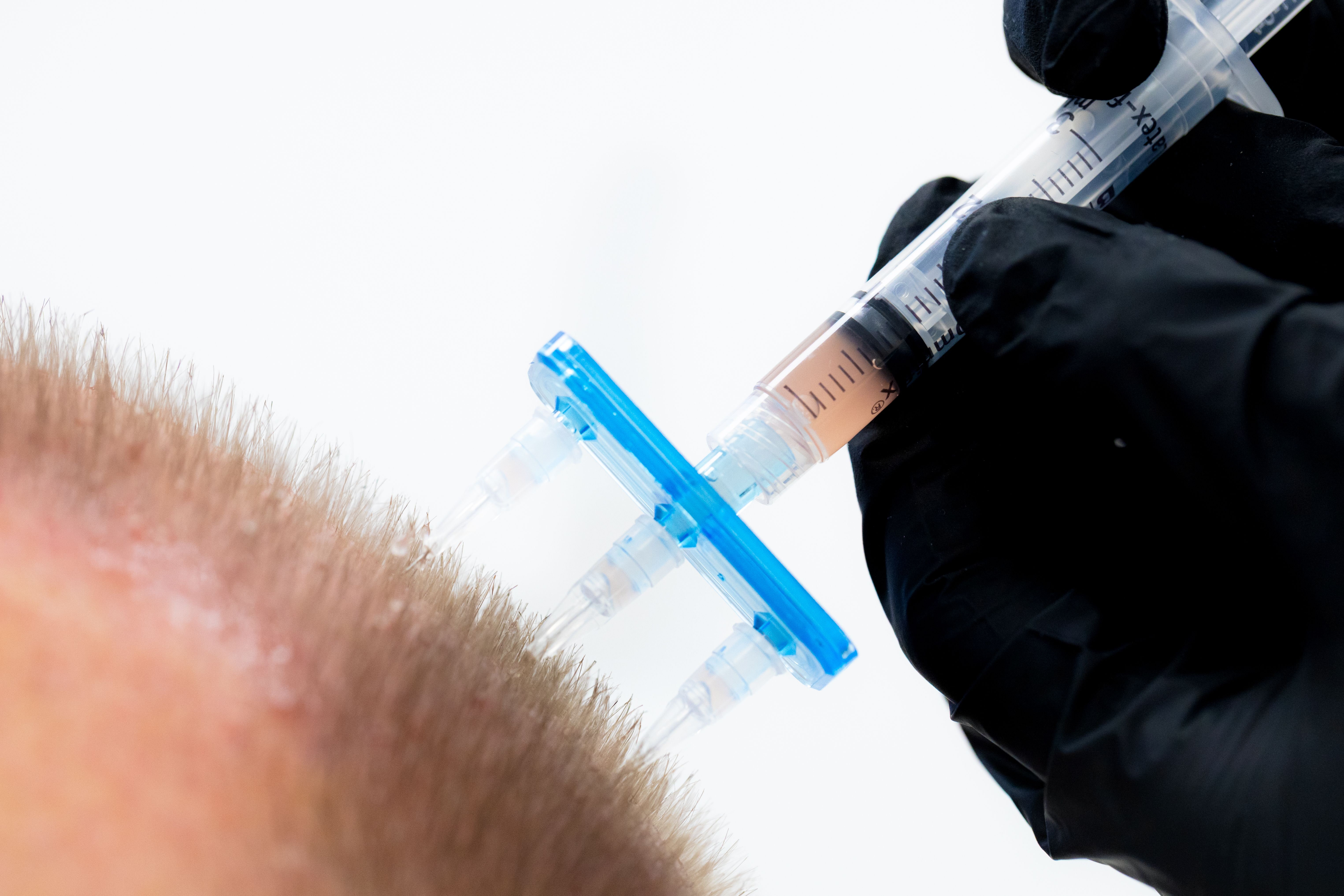 Naturlig metod med kroppens egna celler
