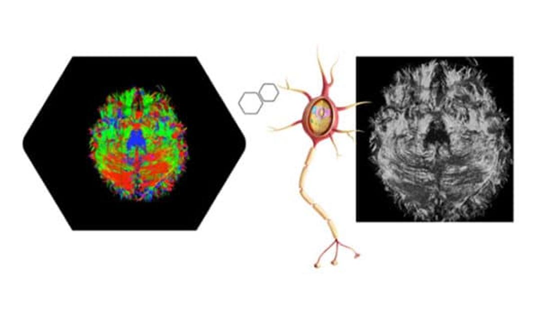 Trauma Brain Injury (TBI) Impact - Insight | Brain Mapping Solutions