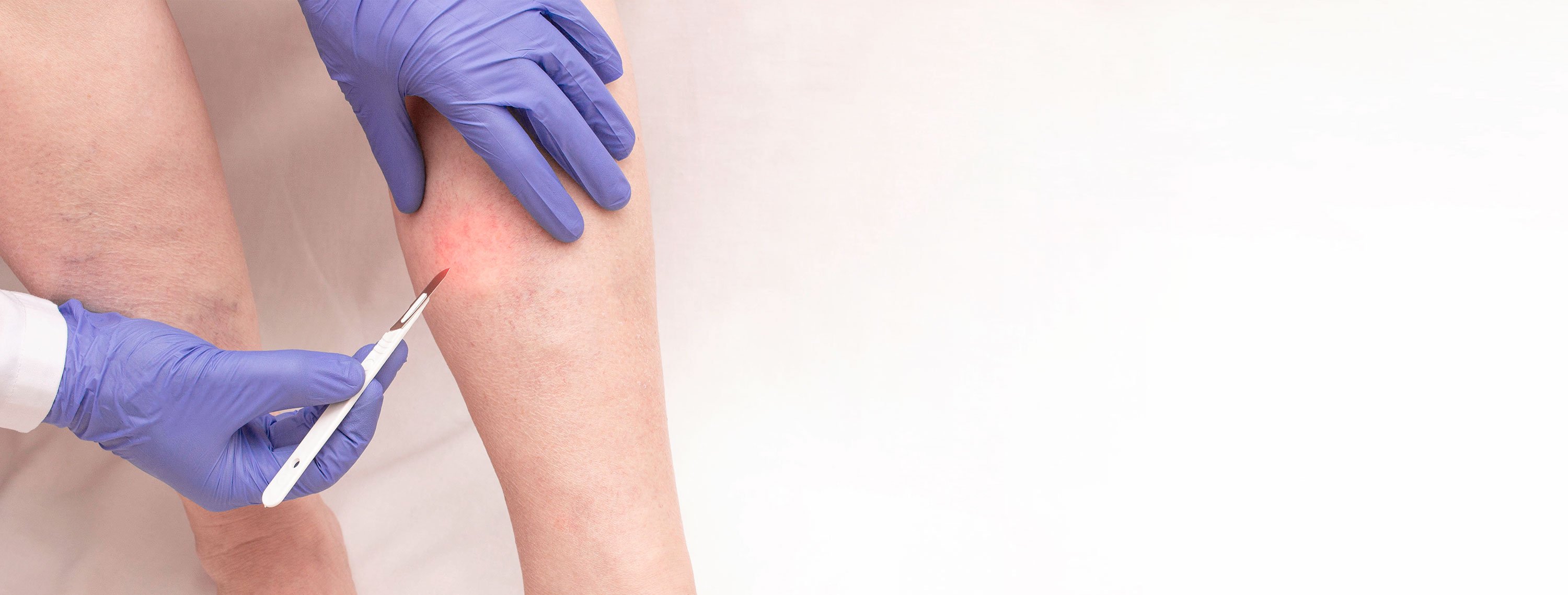 Vein removal being done on a patients leg