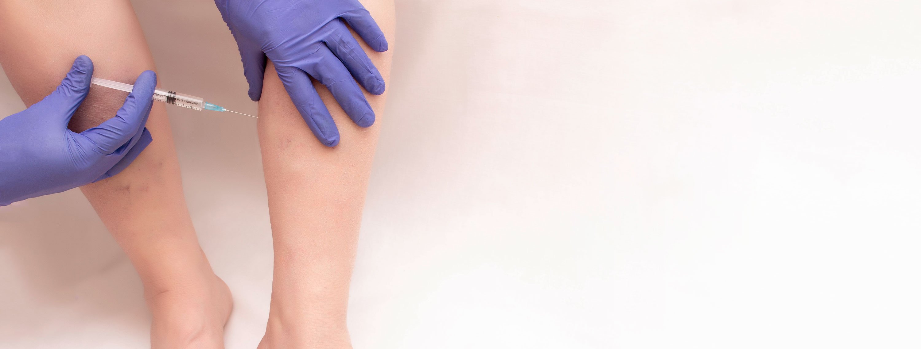 Sclerotherapy being done on patients leg