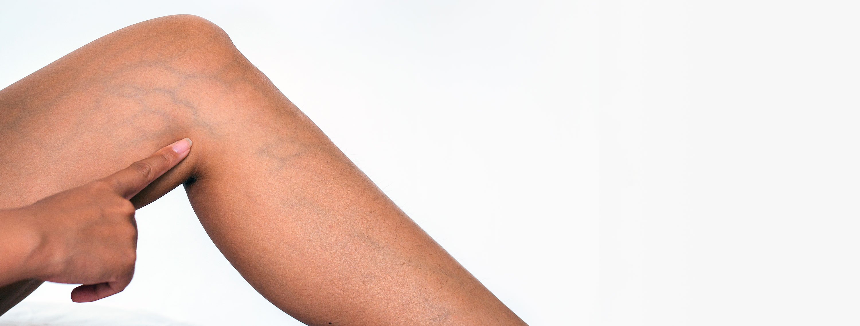 Varicose vein ablation Varicose vein ablation