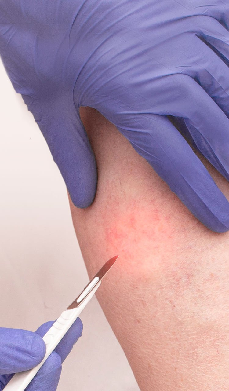 Vein removal being done on a patients leg