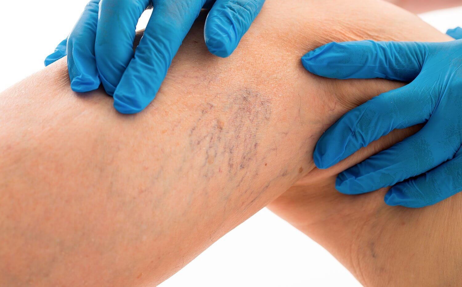 vein therapy