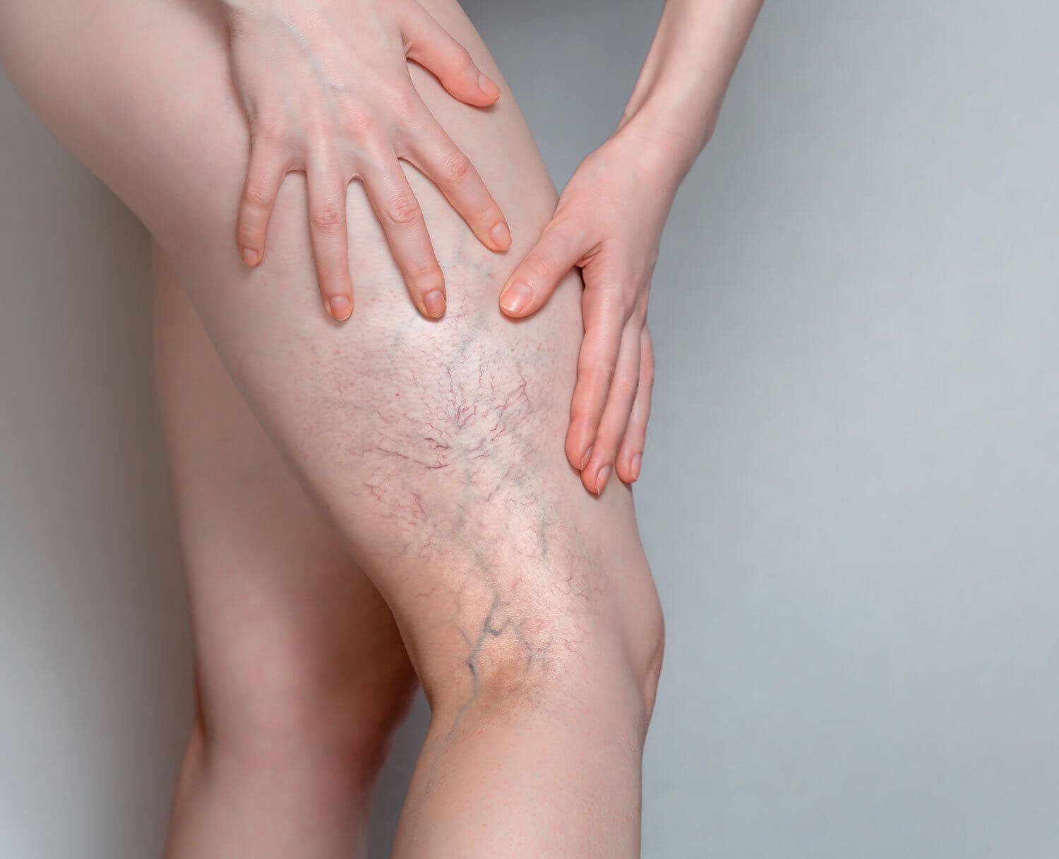 vein treatment