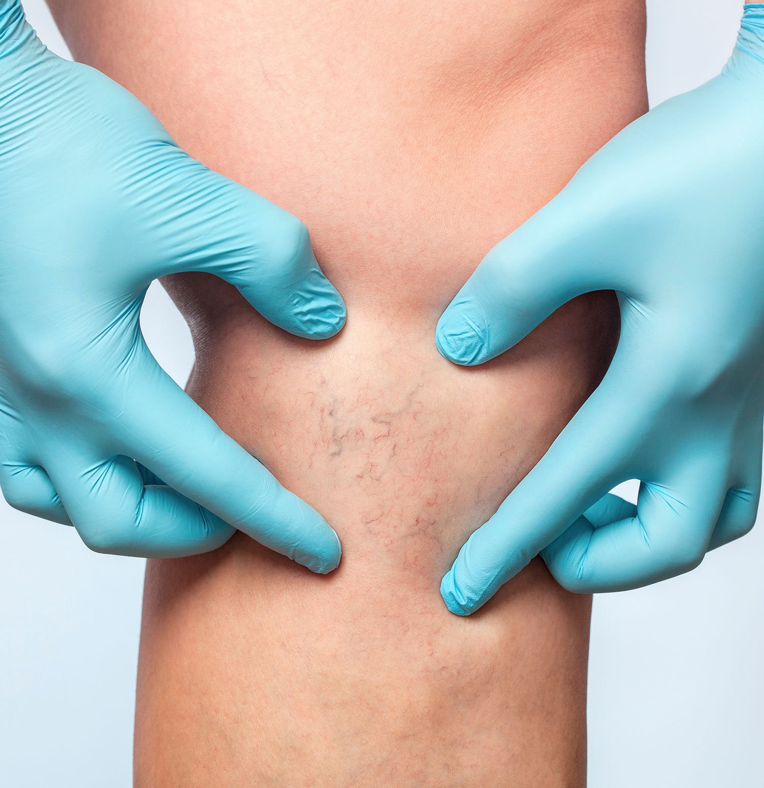 venous insufficiency treatment venous insufficiency treatment