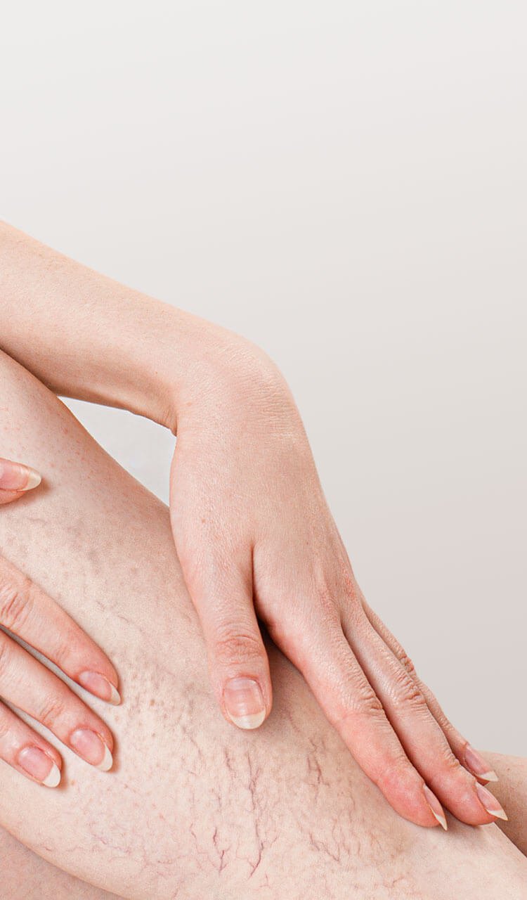 Spider vein treatment near me Spider vein treatment near me