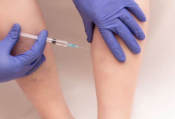 sclerotherapy veins