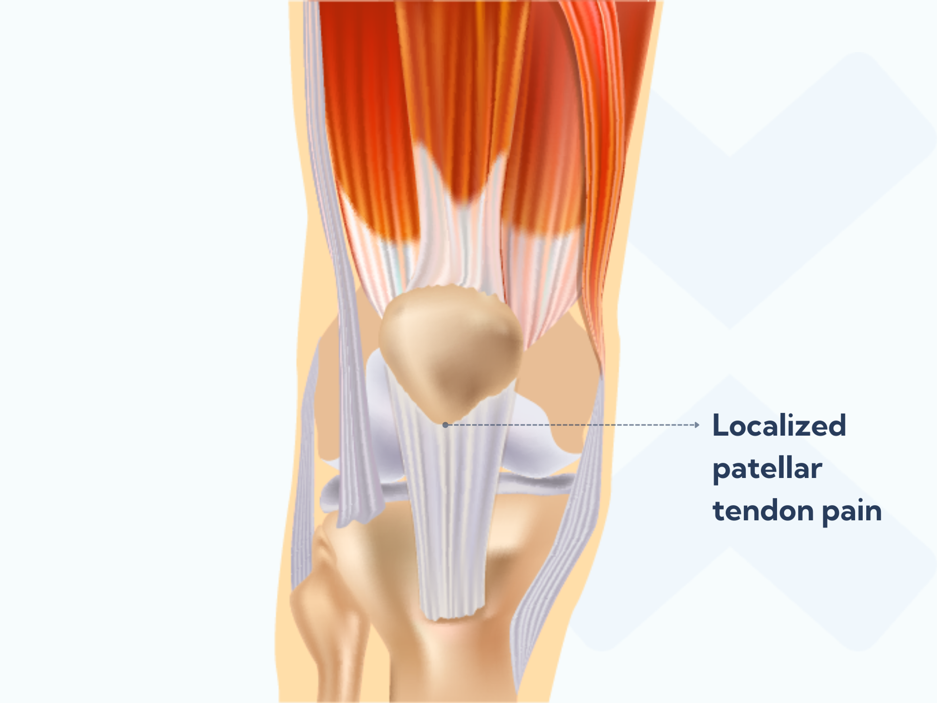 Patellar tendonitis: The comprehensive guide all runners need to read