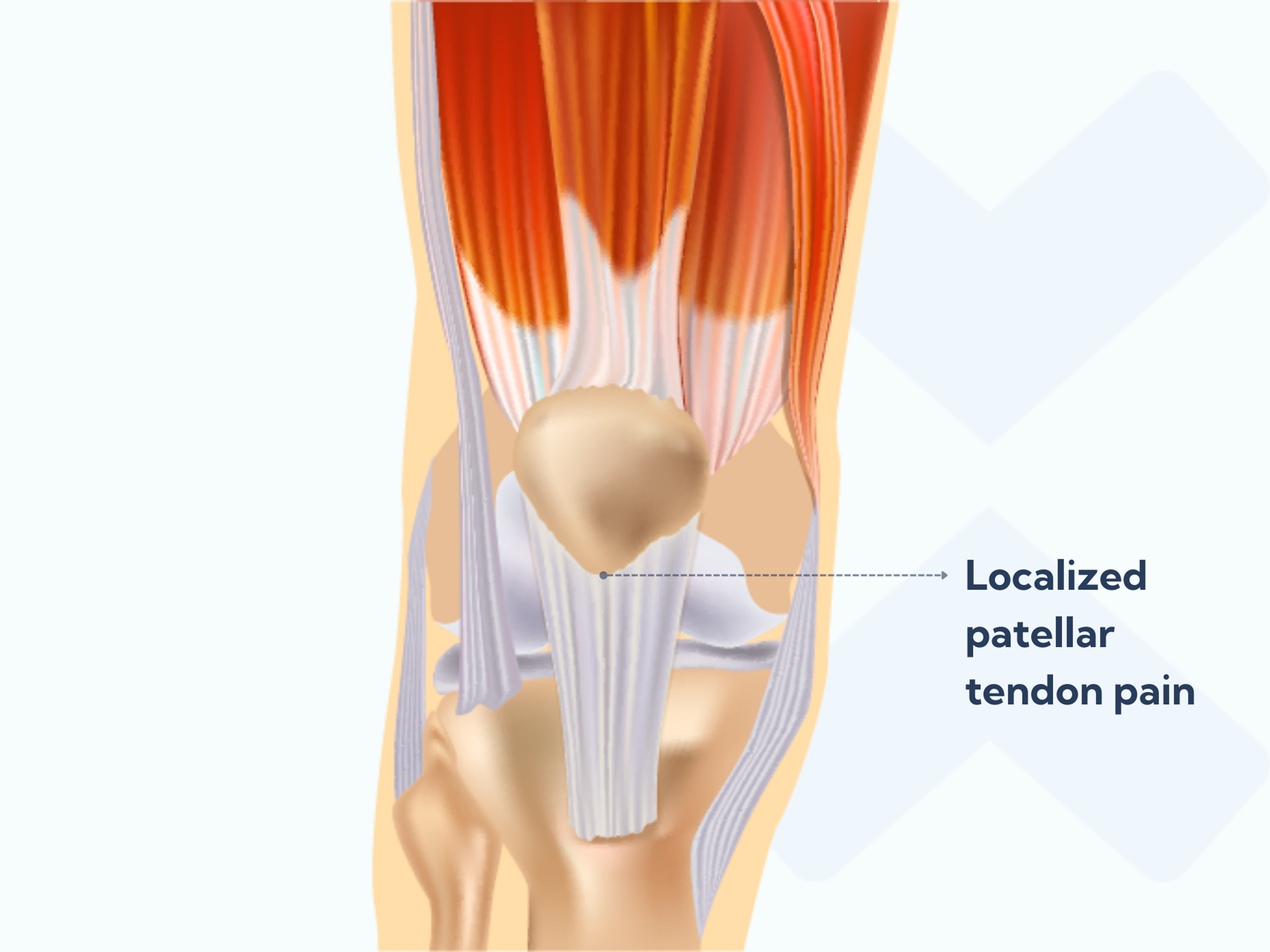 When you have patellar tendonitis the pain is localized to the patellar tendon, most commonly where it attaches to the kneecap.