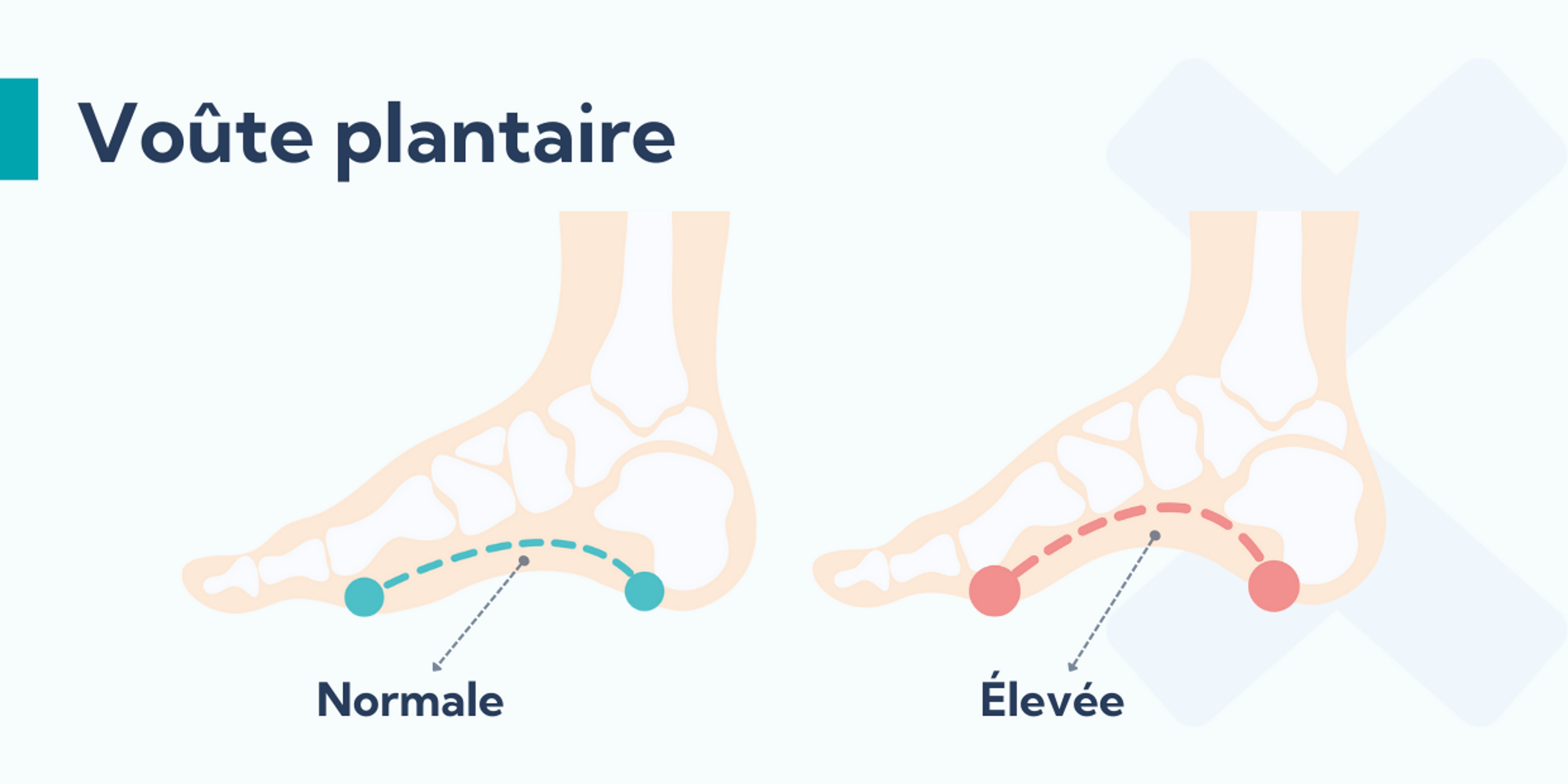 Une voûte plantaire élevée peut être à l'origine d'une périostite tibiale