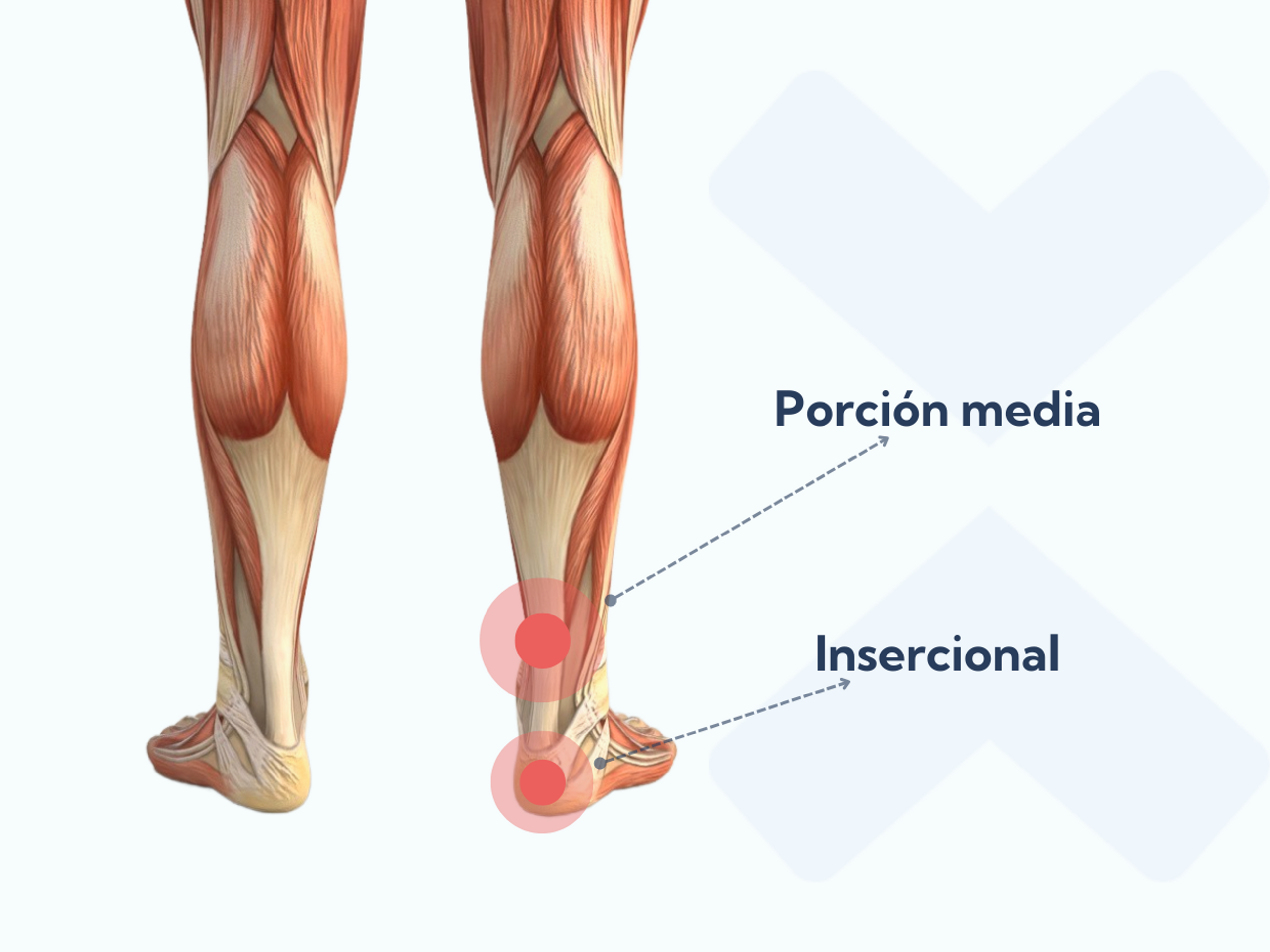 La tendinopatía de la porción media del tendón de Aquiles se desarrolla aproximadamente 5 centímetros por encima del hueso del talón, mientras que la tendinopatía insercional de Aquiles surge en el punto donde el tendón se une al hueso del talón.