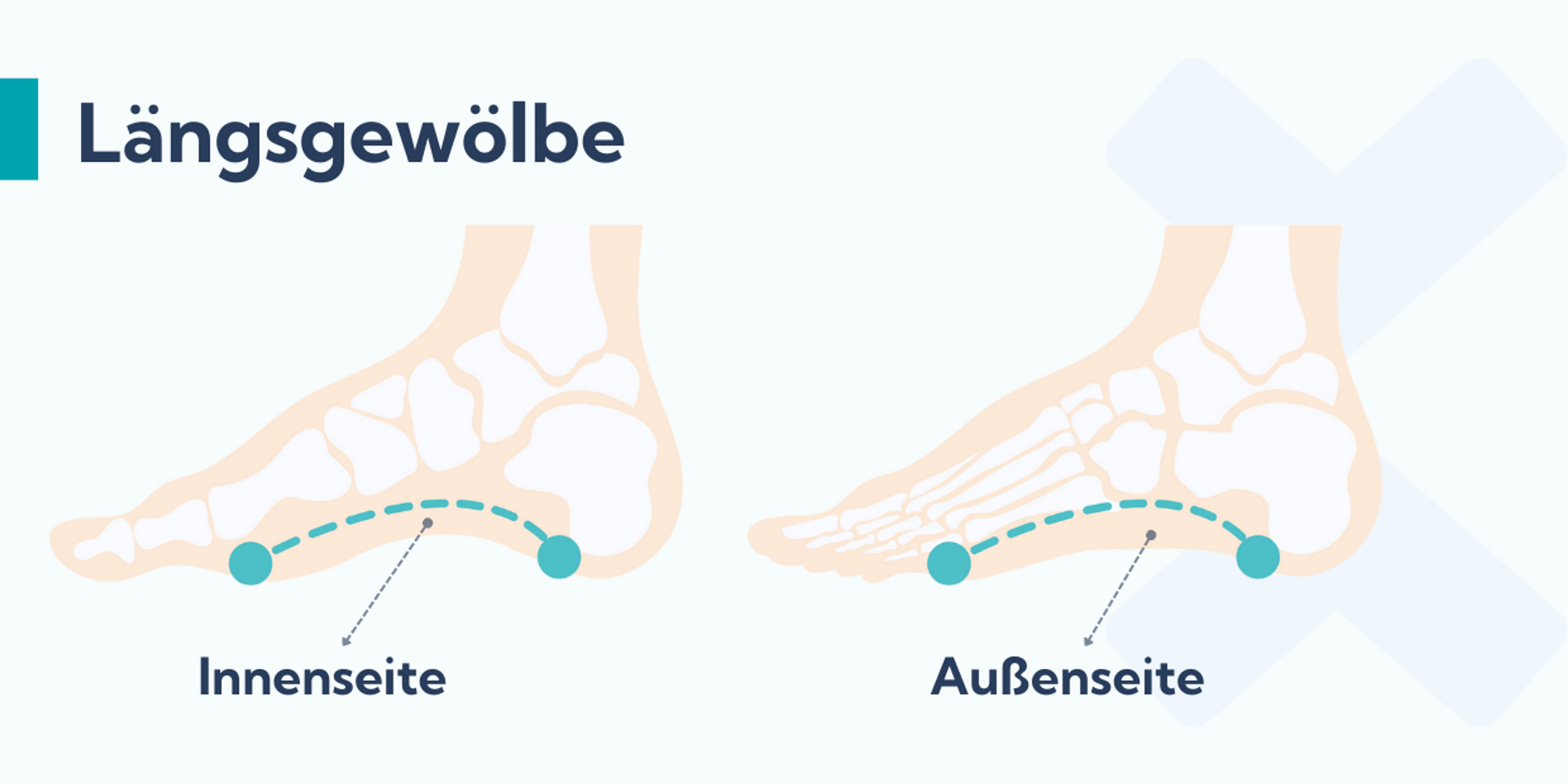 Das äußere Längsgewölbe verläuft auf der Außenseite des Fußes, das innere Längsgewölbe auf der Innenseite des Fußes. Patienten mit Schienbeinkantensyndrom verwenden Einlagen, um diese Fußbögen zu stützen.