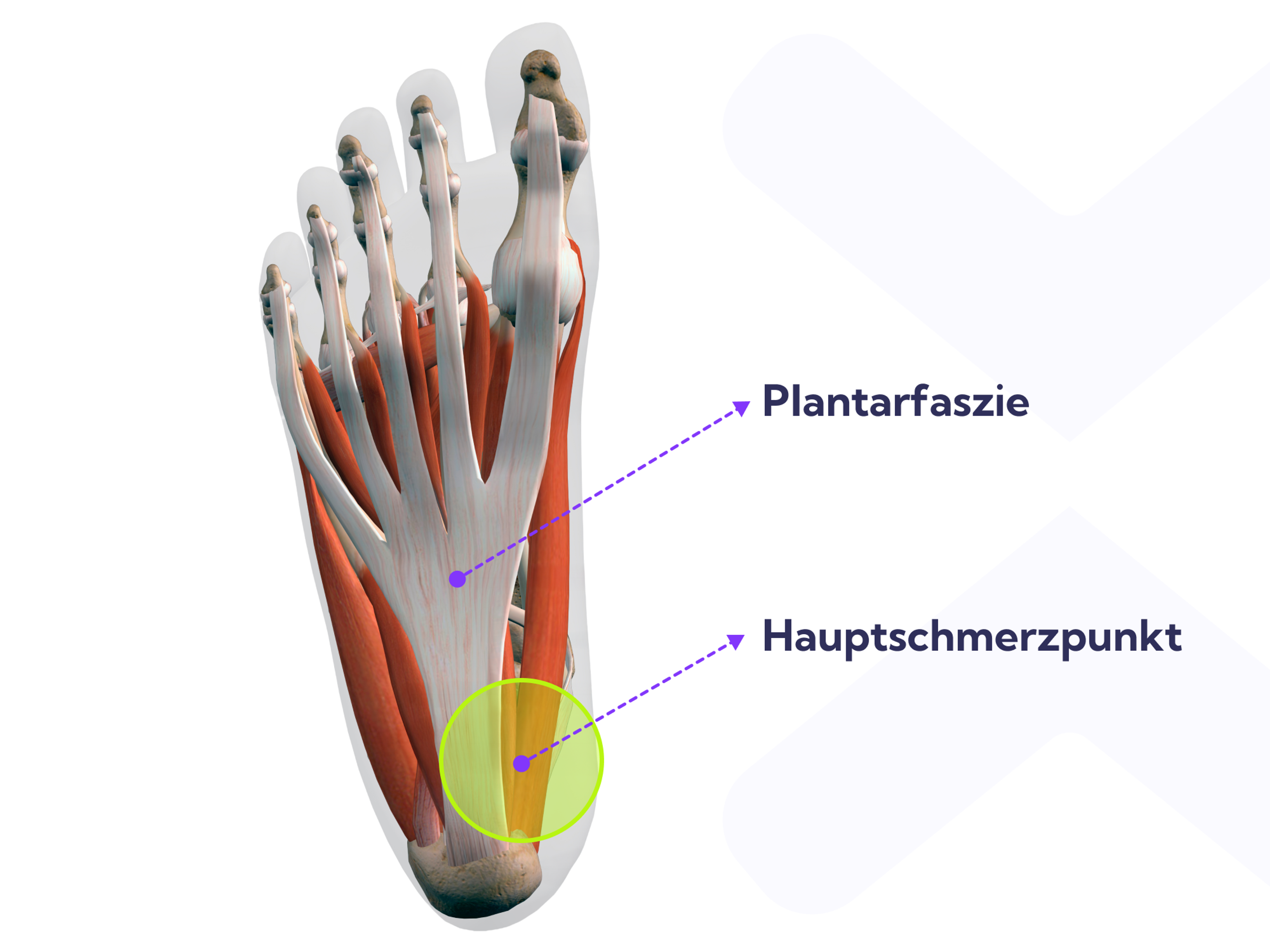 Die Diagnose Plantarfasziitis weist auf eine Verletzung der Plantarfaszie hin.