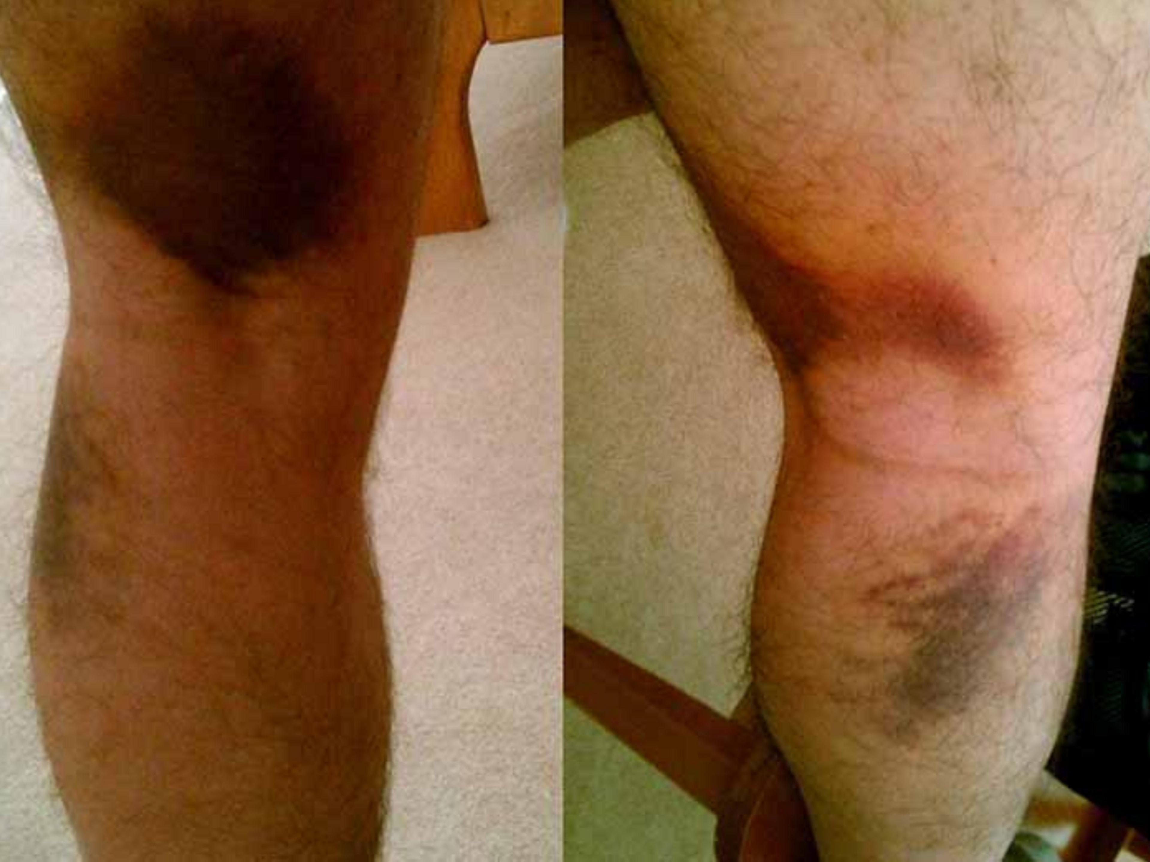 Bei einer Zerrung oder einem Muskelriss im Oberschenkel erscheint der Bluterguss oft weiter unten am Bein.