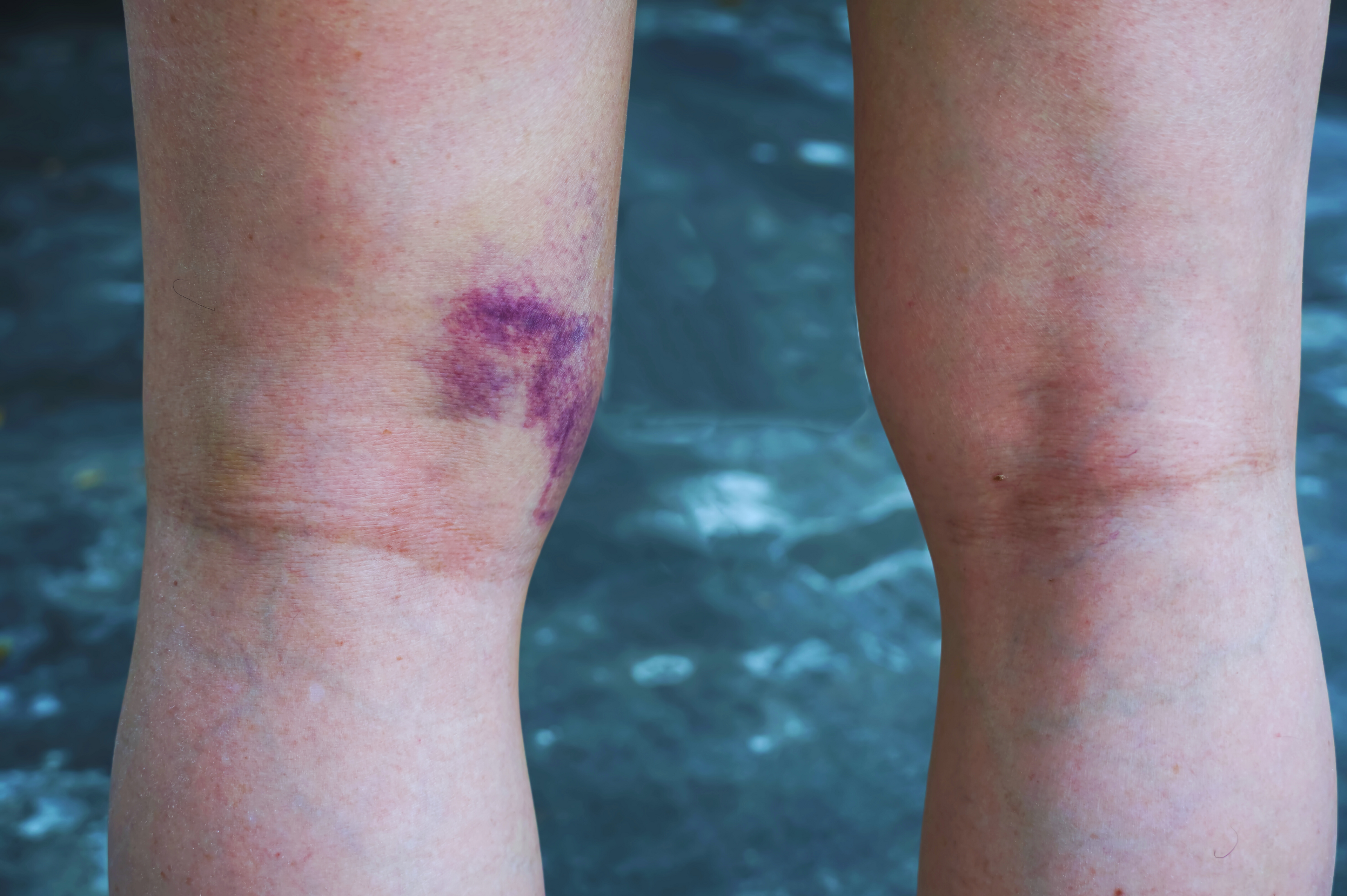 When you pull a hamstring, the bruise often shows lower down the leg.
