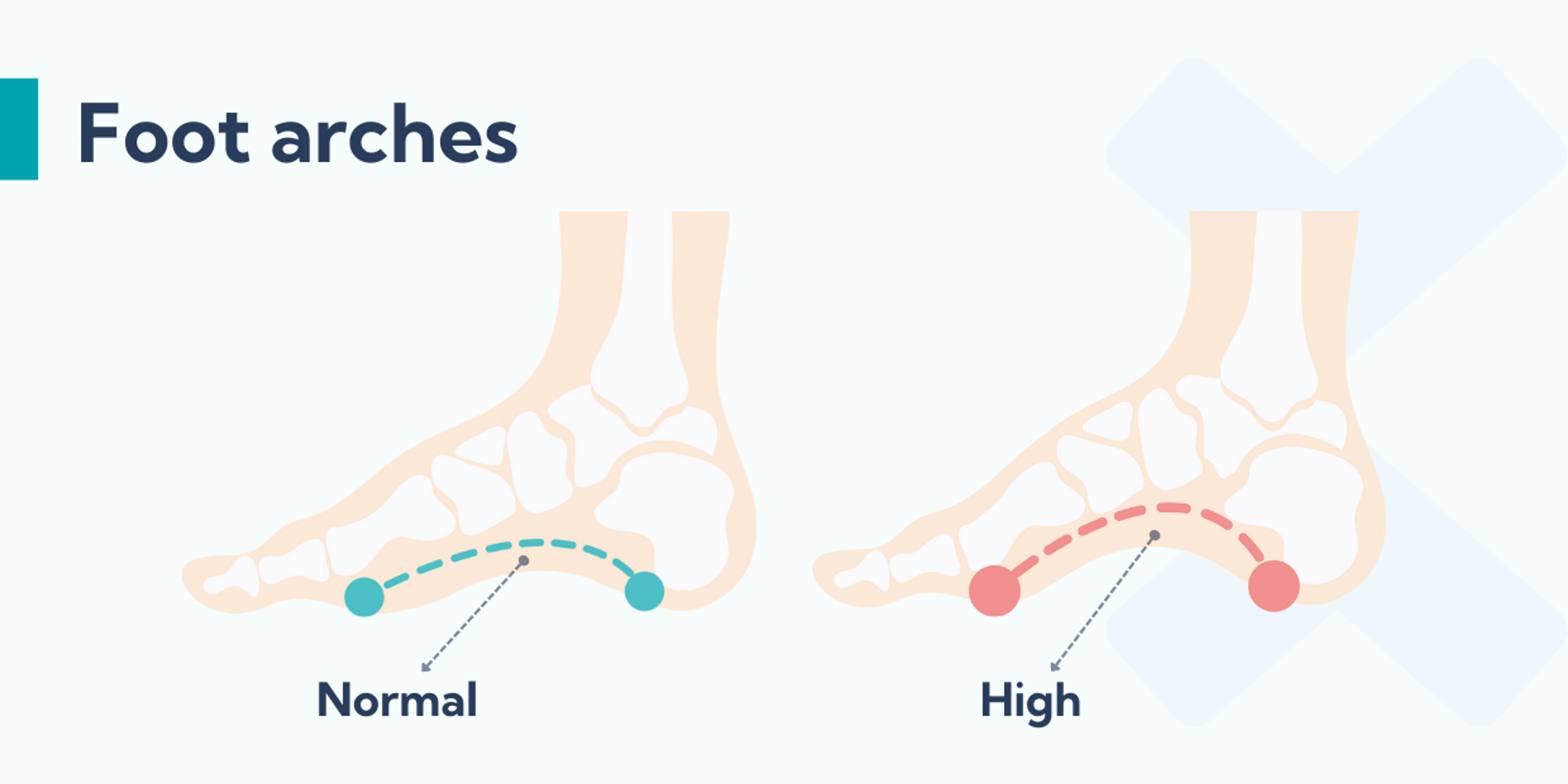 High foot arches can predispose you to getting insertional Achilles tendonitis.