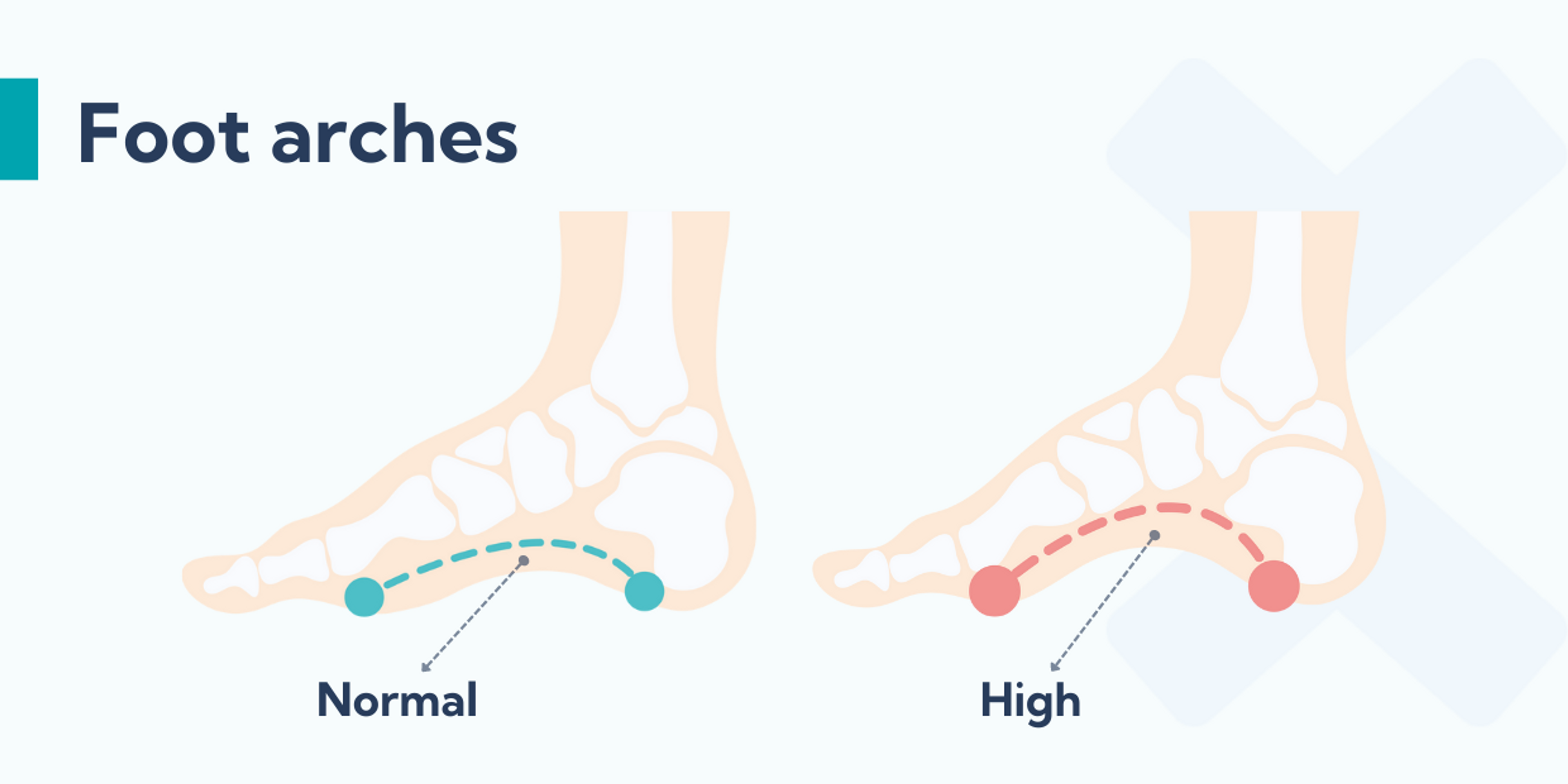 Can insoles help with shin splints? (and how to choose the right ones)