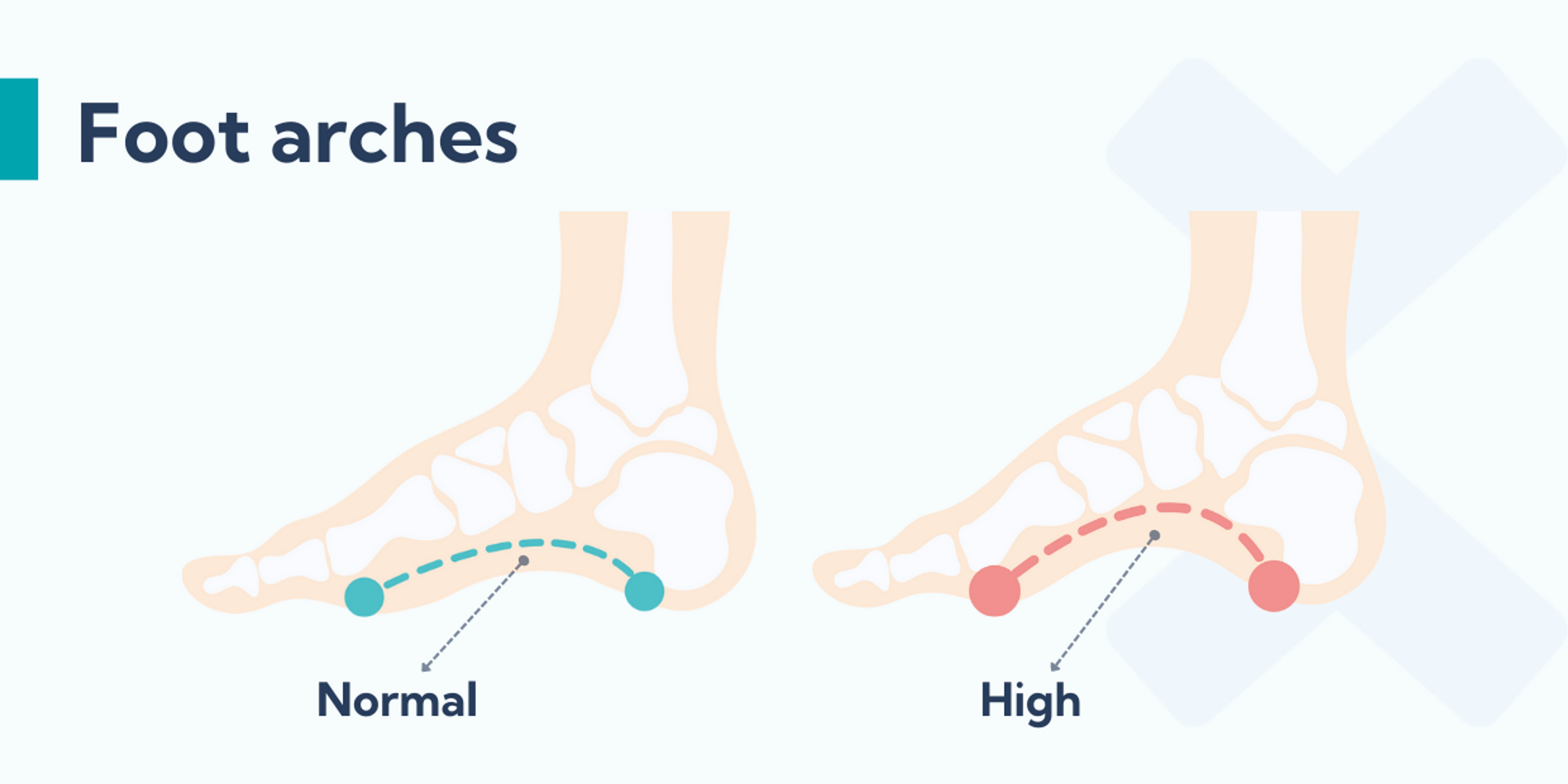 High arches can cause shin splints.