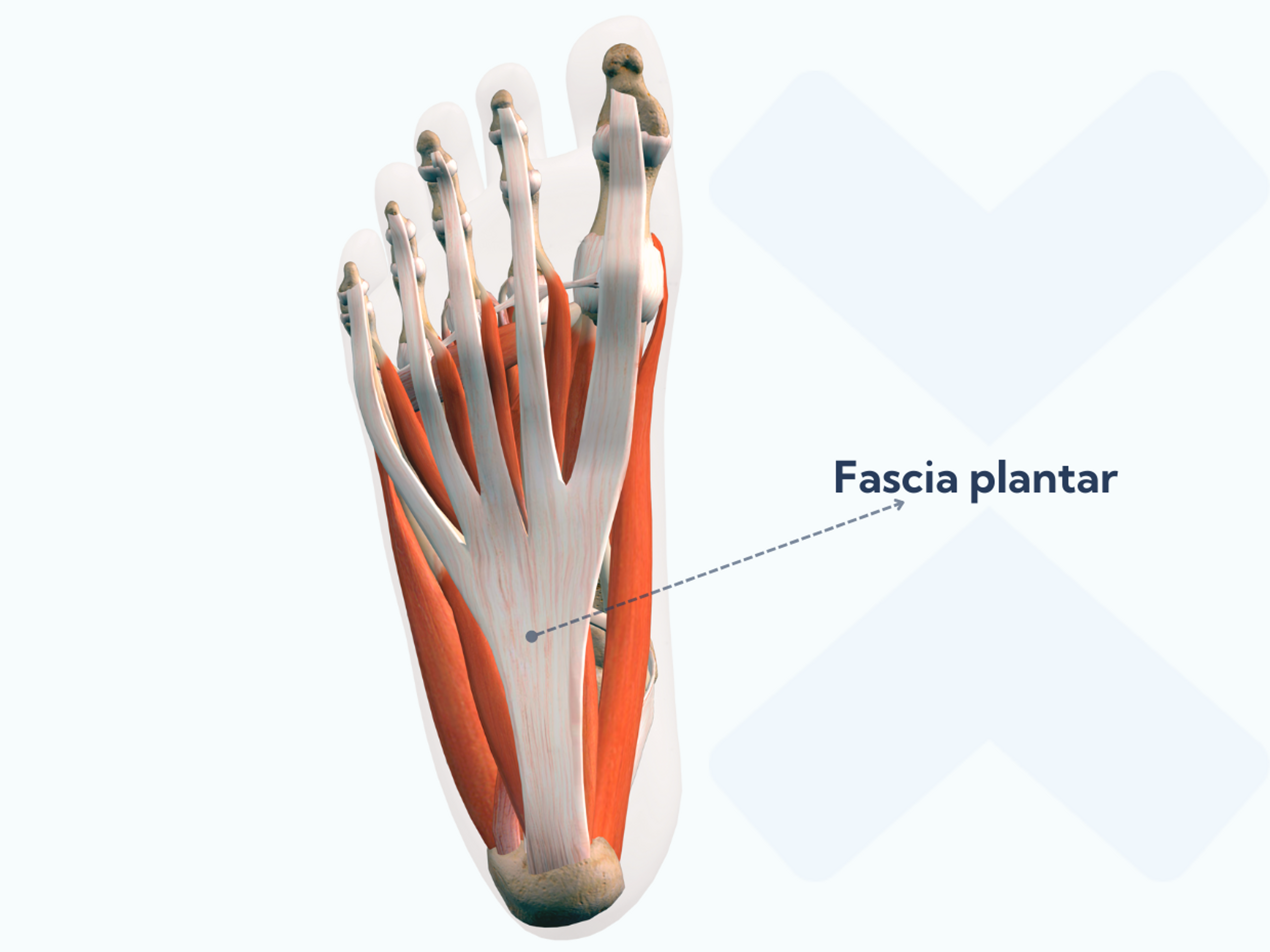 El dolor de la fascitis plantar se localiza en la zona de conexión medial con el hueso del talón.
