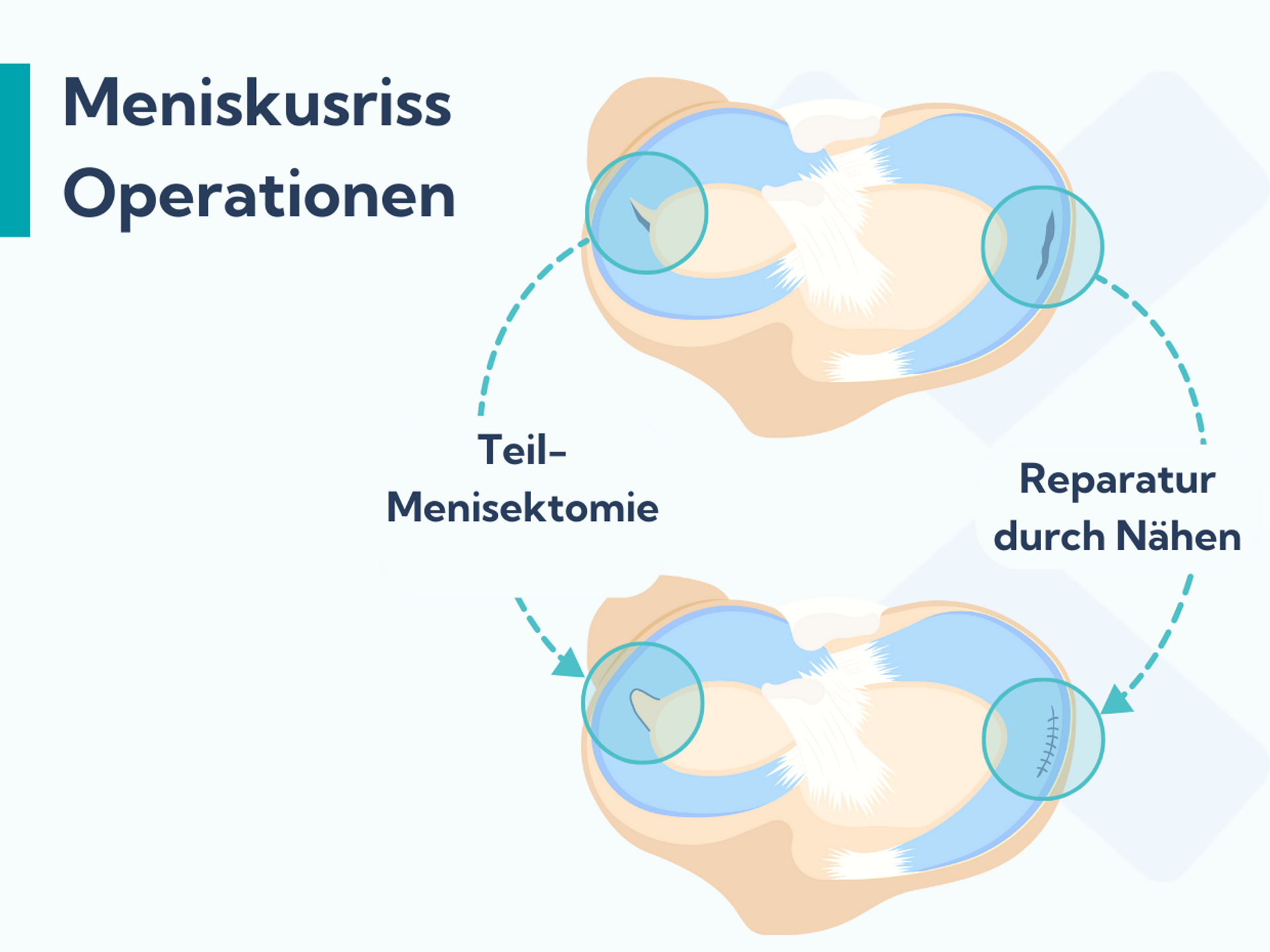 Alles über Meniskusrisse: Symptome, Ursachen und Behandlung