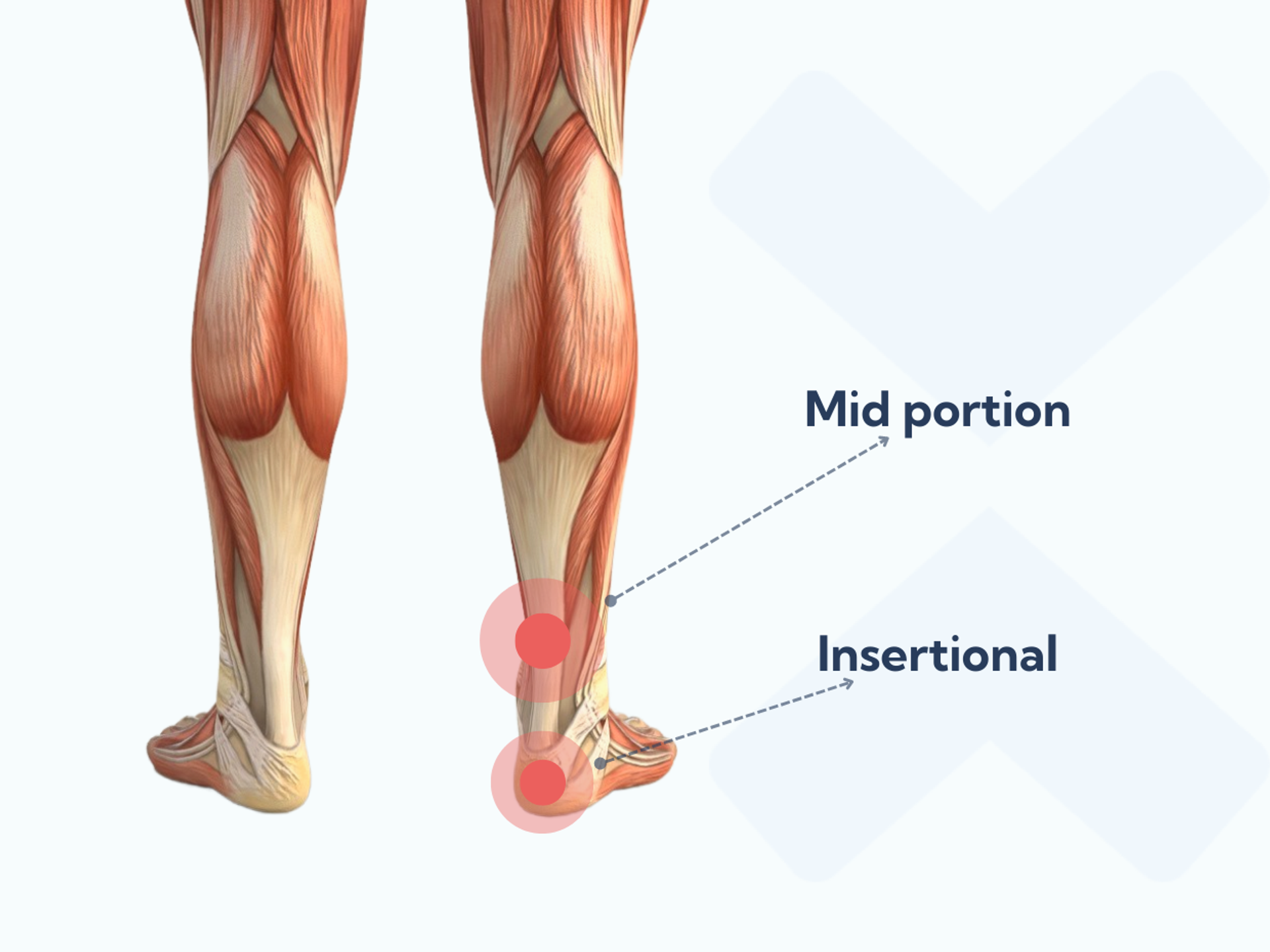 Achilles tendonitis in runners: Causes, symptoms, treatments, and ...