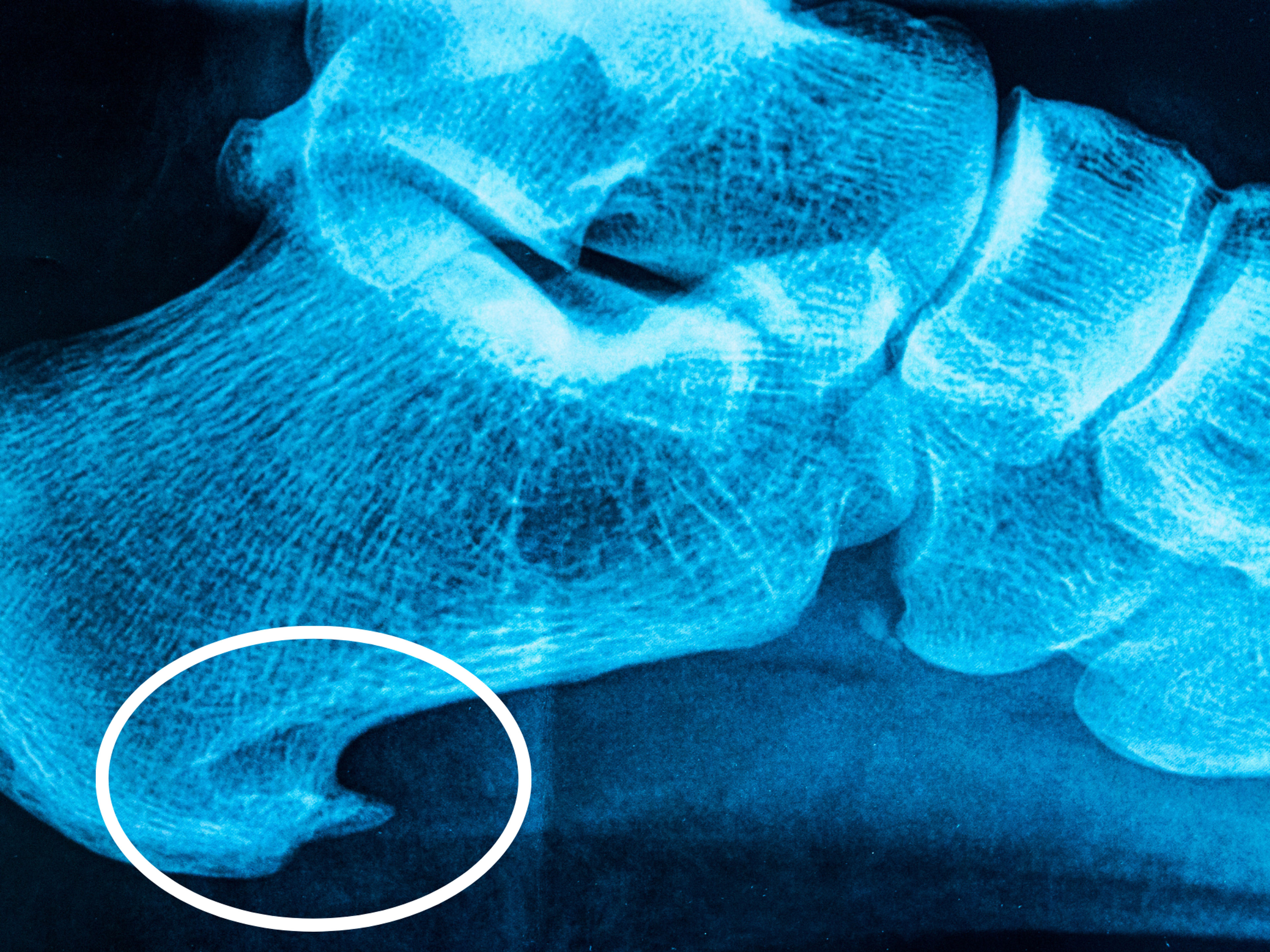 Heel spurs appear on x-rays as bony points in the area where the plantar fascia attaches to the heel bone.