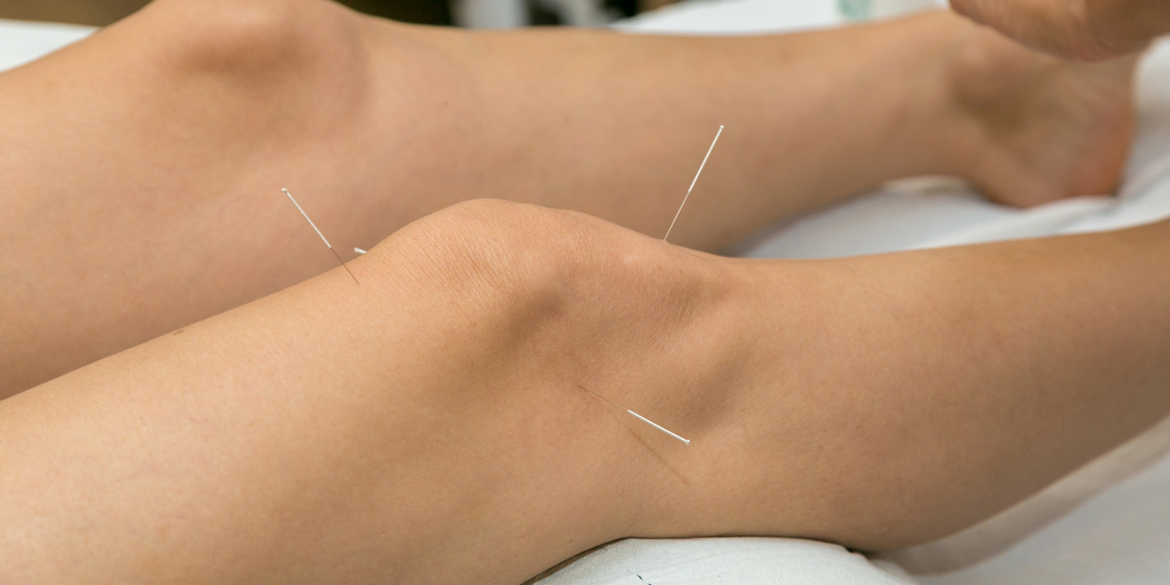 Acupuncture pour une rupture du ménisque