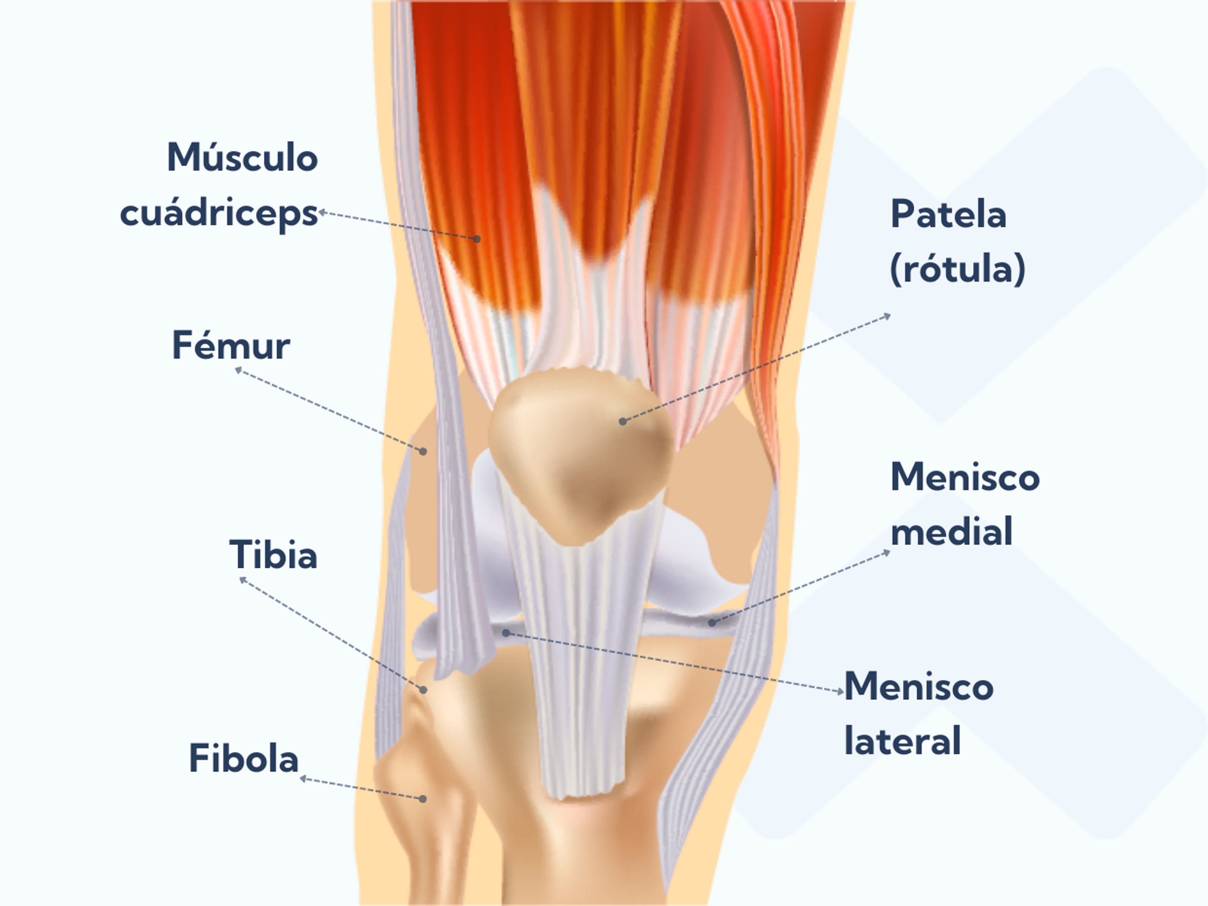 Sólo tendrás hinchazón en la rodilla después de sufrir un esguince si te lesionas una estructura que se encuentra dentro de la articulación de la rodilla.