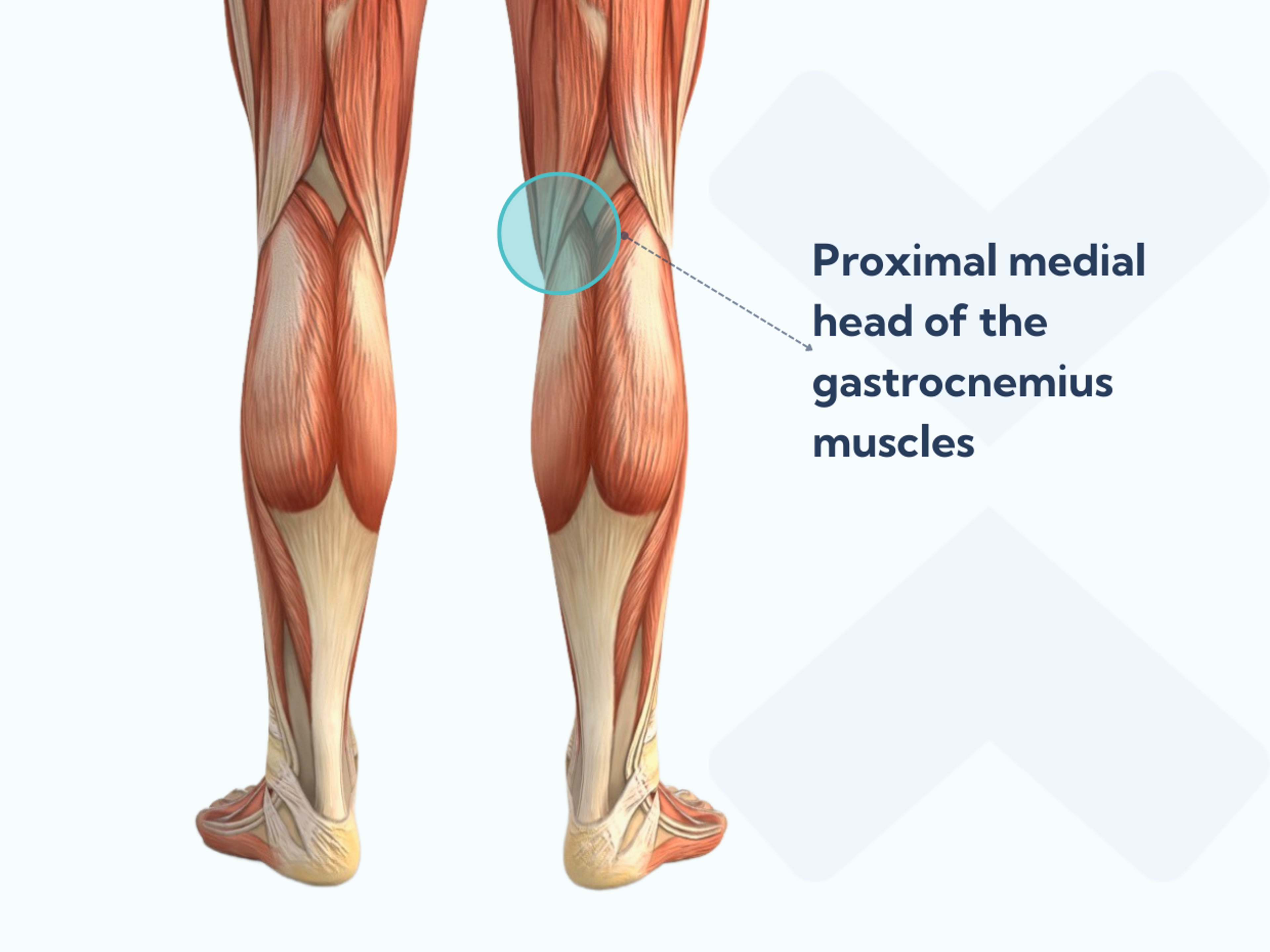 Isolated medial proximal gastrocnemius release surgery for plantar fasciitis involves them cutting the top inner part of the gastrocnemius muscle.