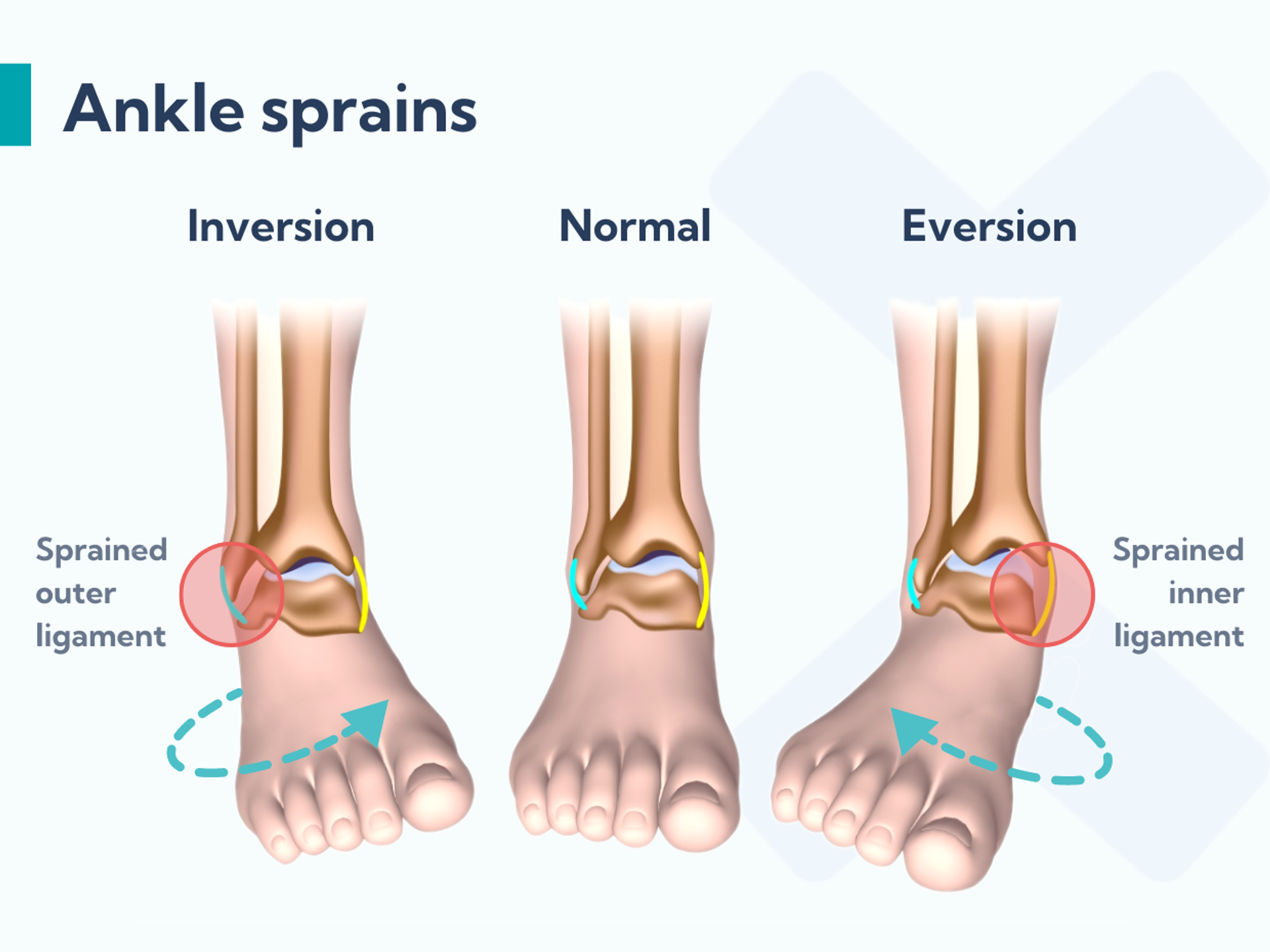 Ankle Sprains The Types Causes And Best Treatments 2500