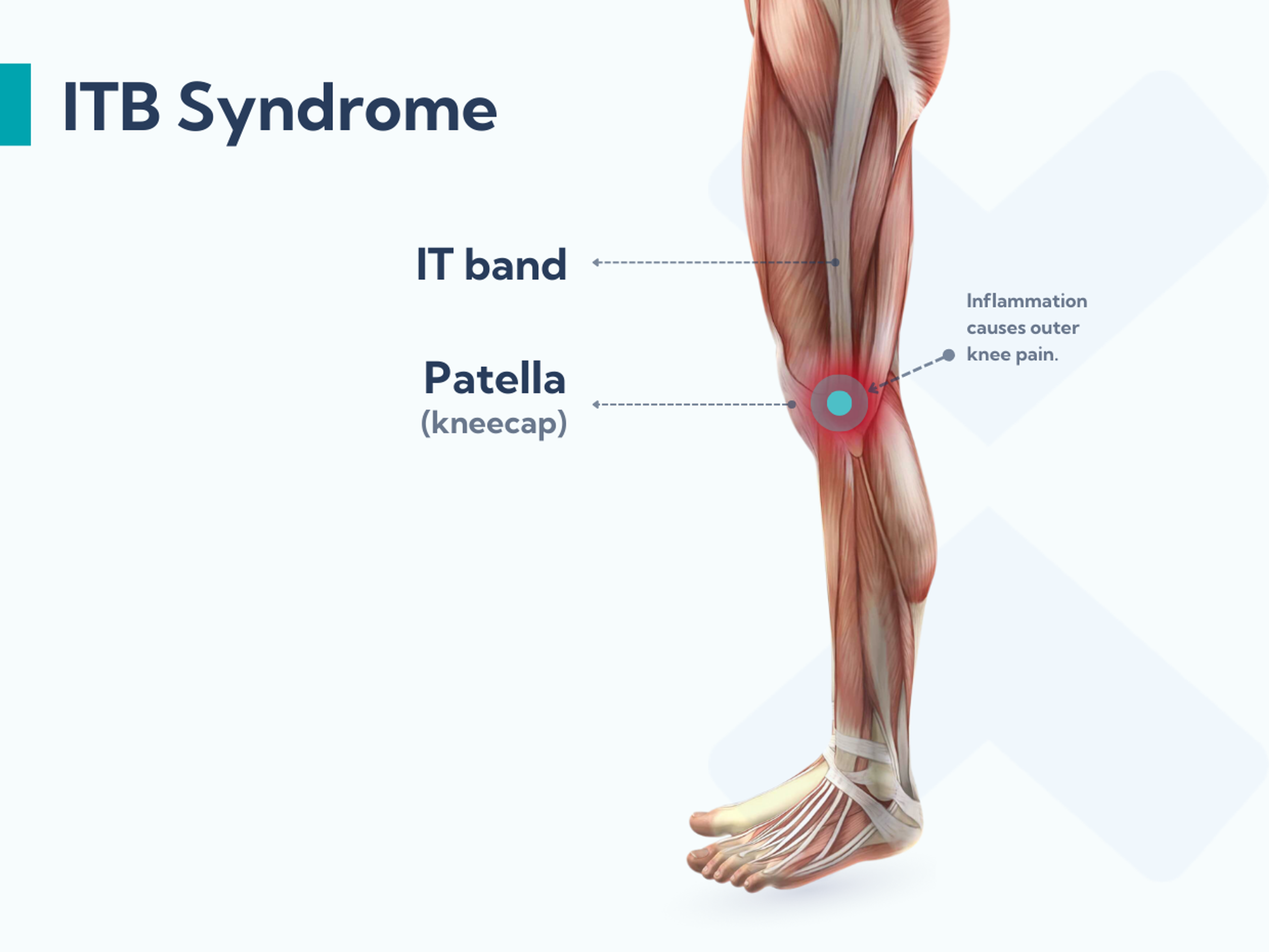 Iliotibial band syndrome is caused by irritation and inflammation in the area where the IT band attaches to the outer knee.